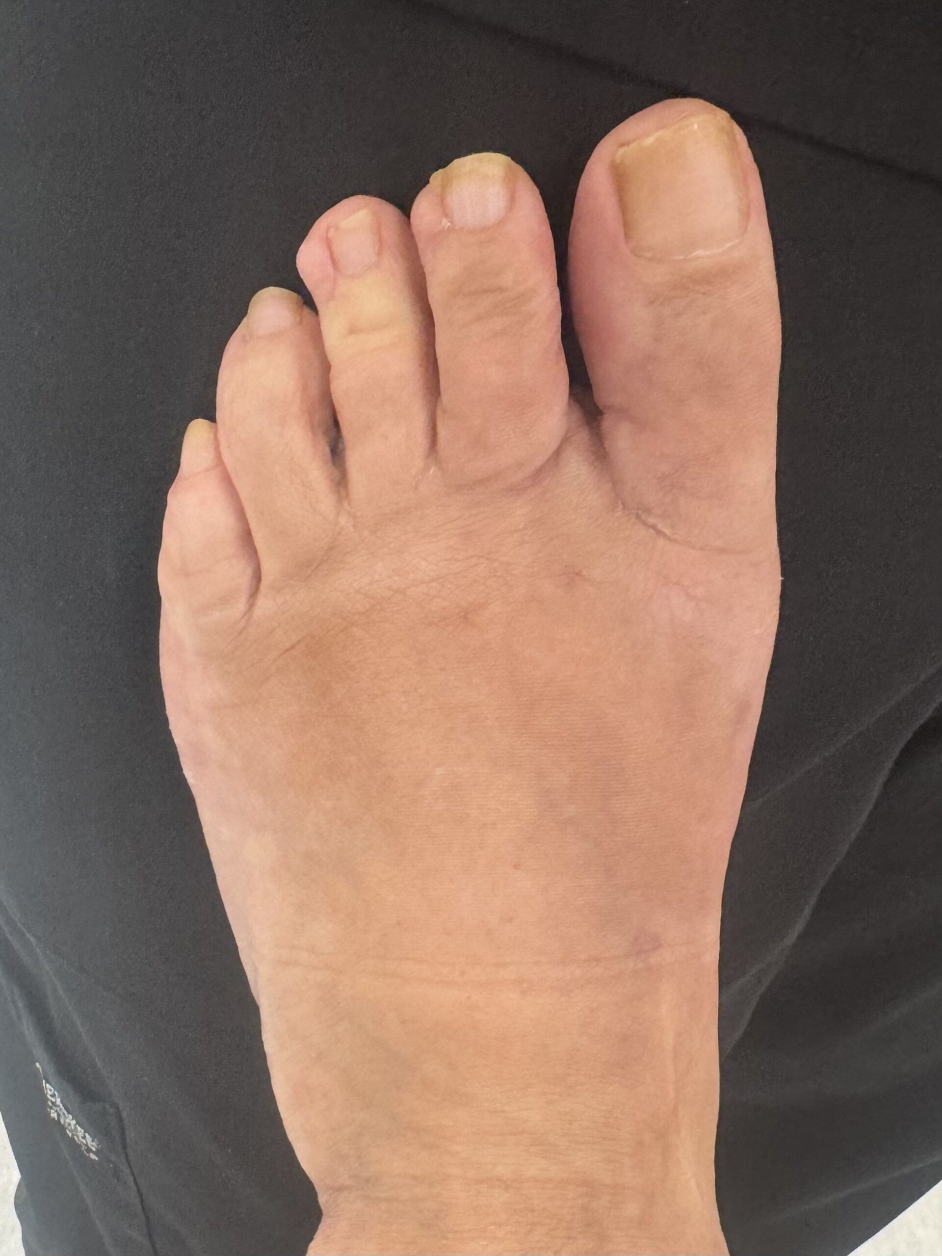 After bunion surgery