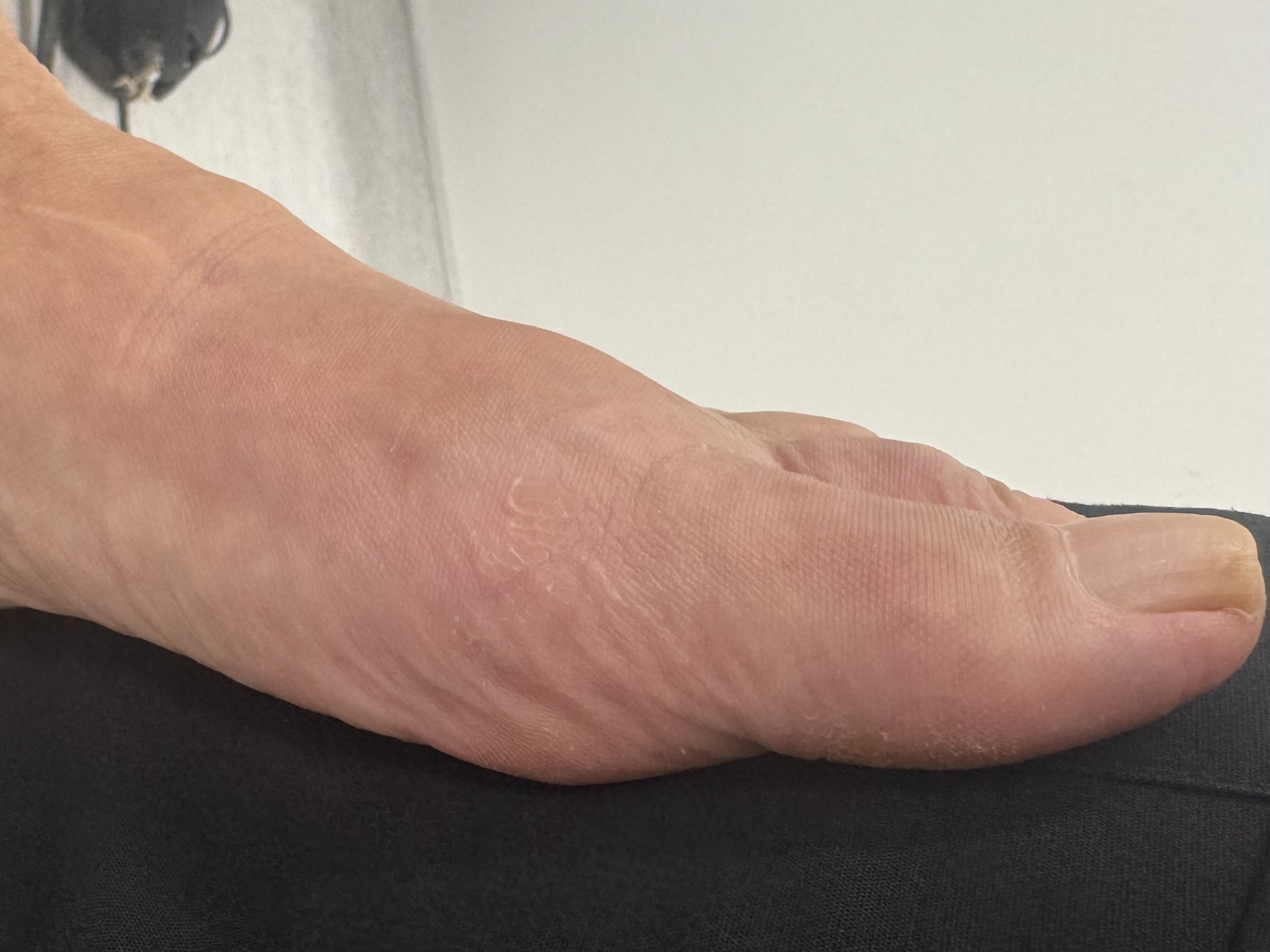 after bunion surgery