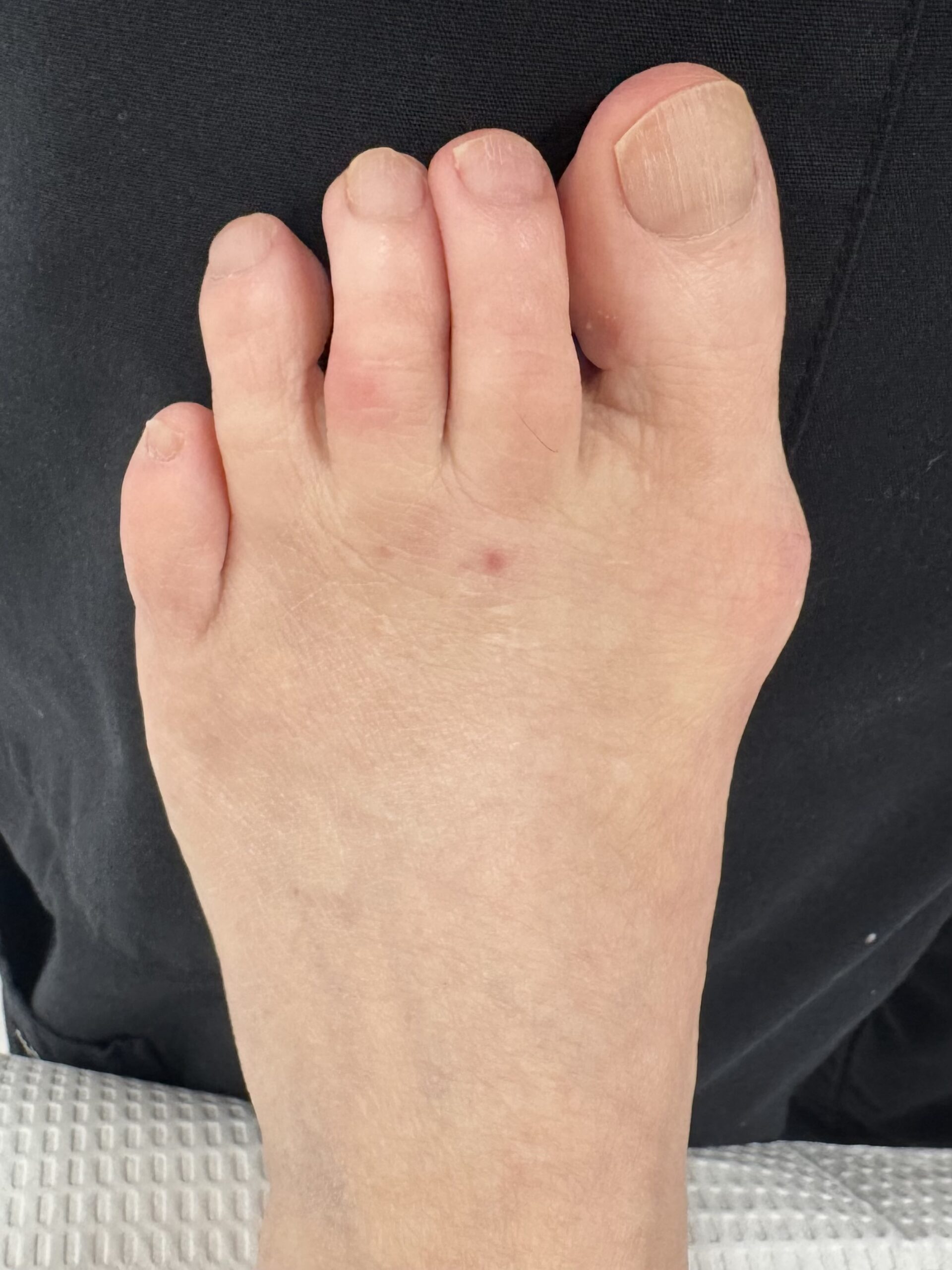 foot after bunion surgery