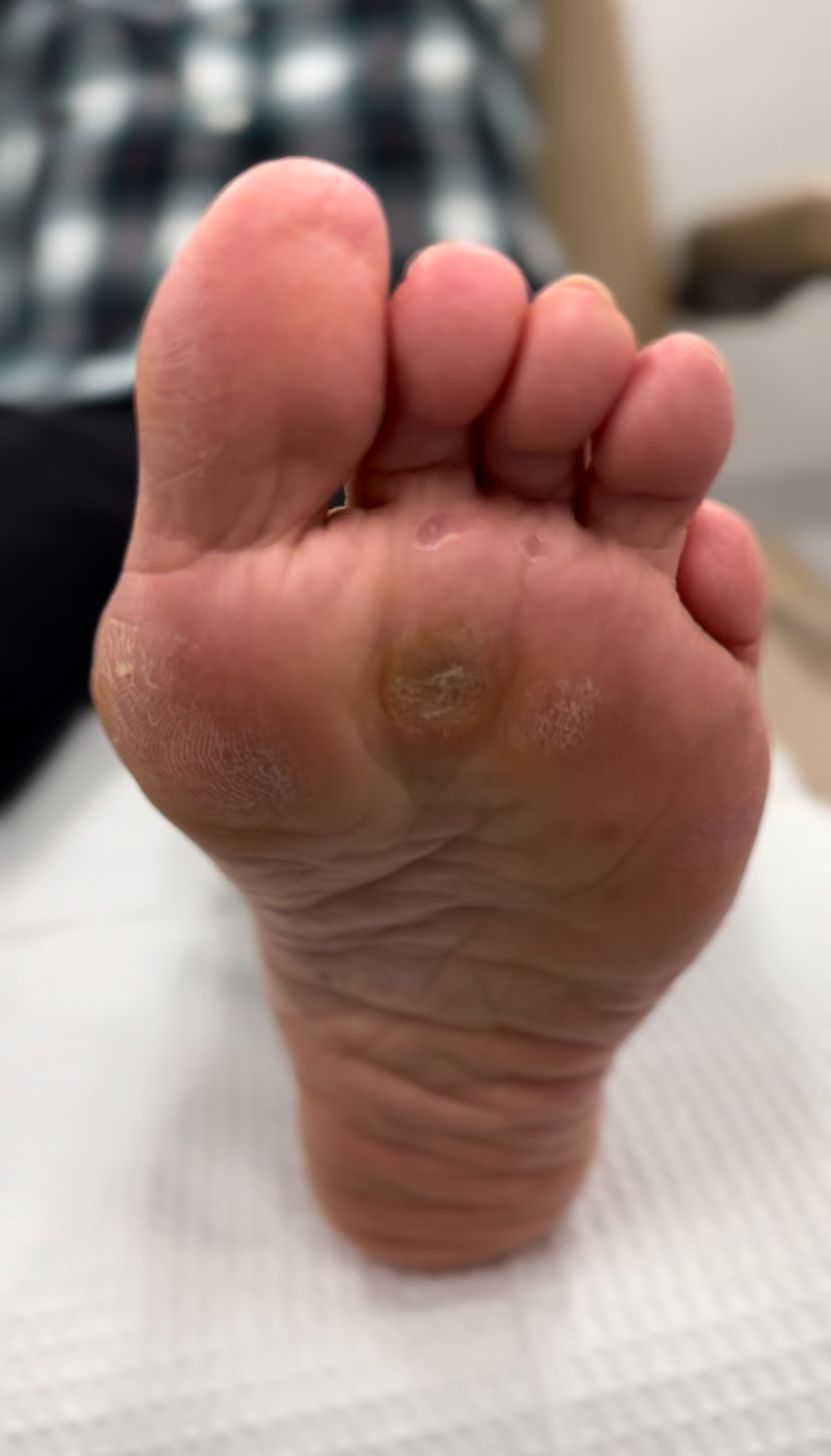 Extreme Bunion after treatment — comparison 22