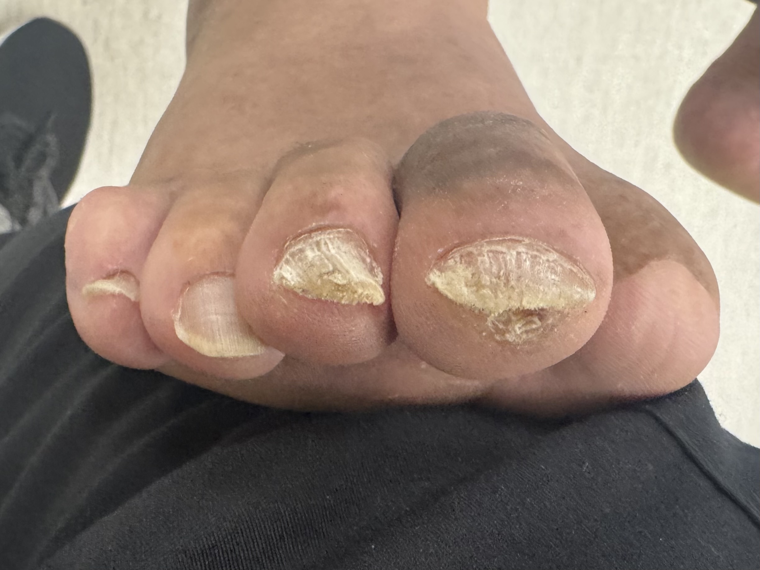 Mallet Toe after treatment — comparison 13
