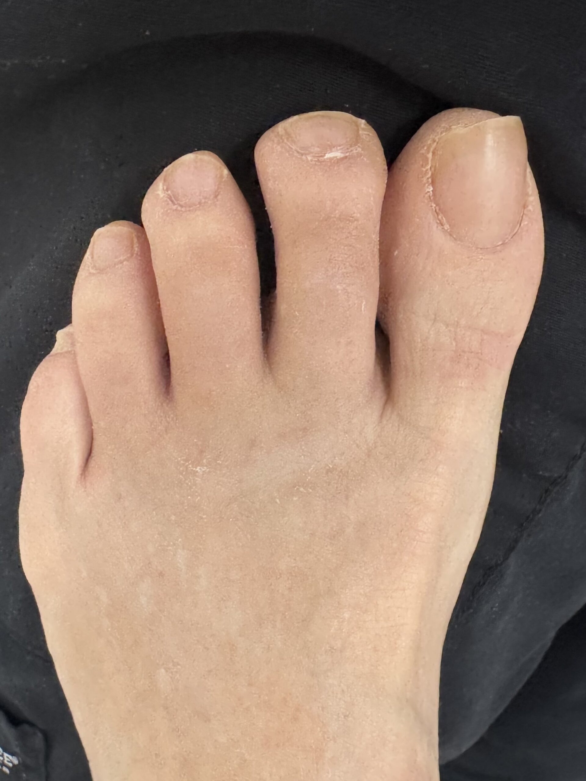 After Surgery