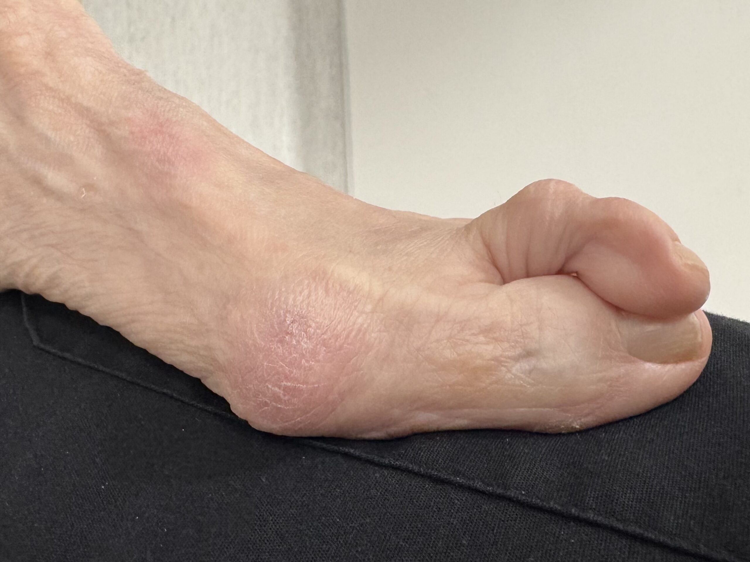 Extreme Bunion before treatment — comparison 18