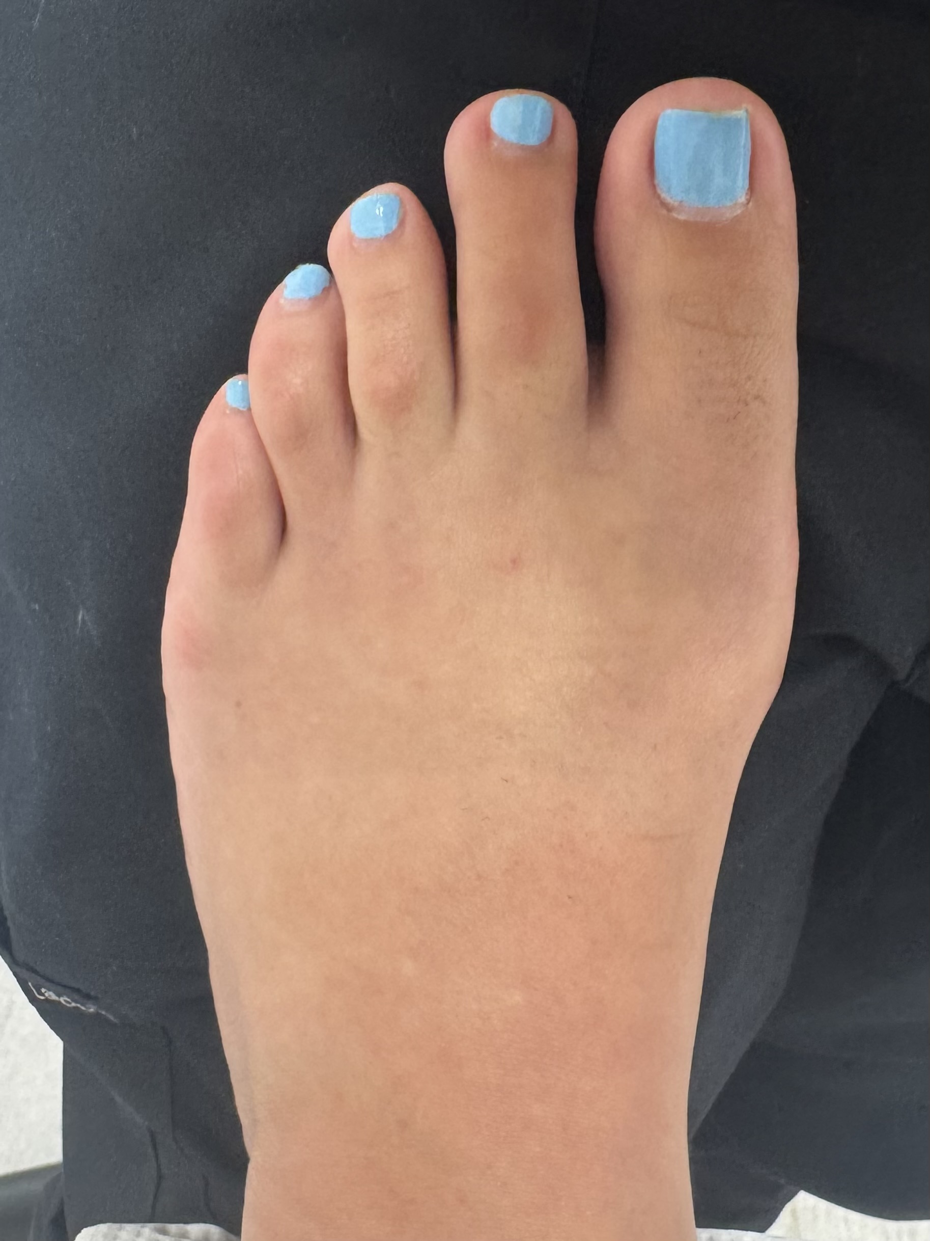 After Surgery