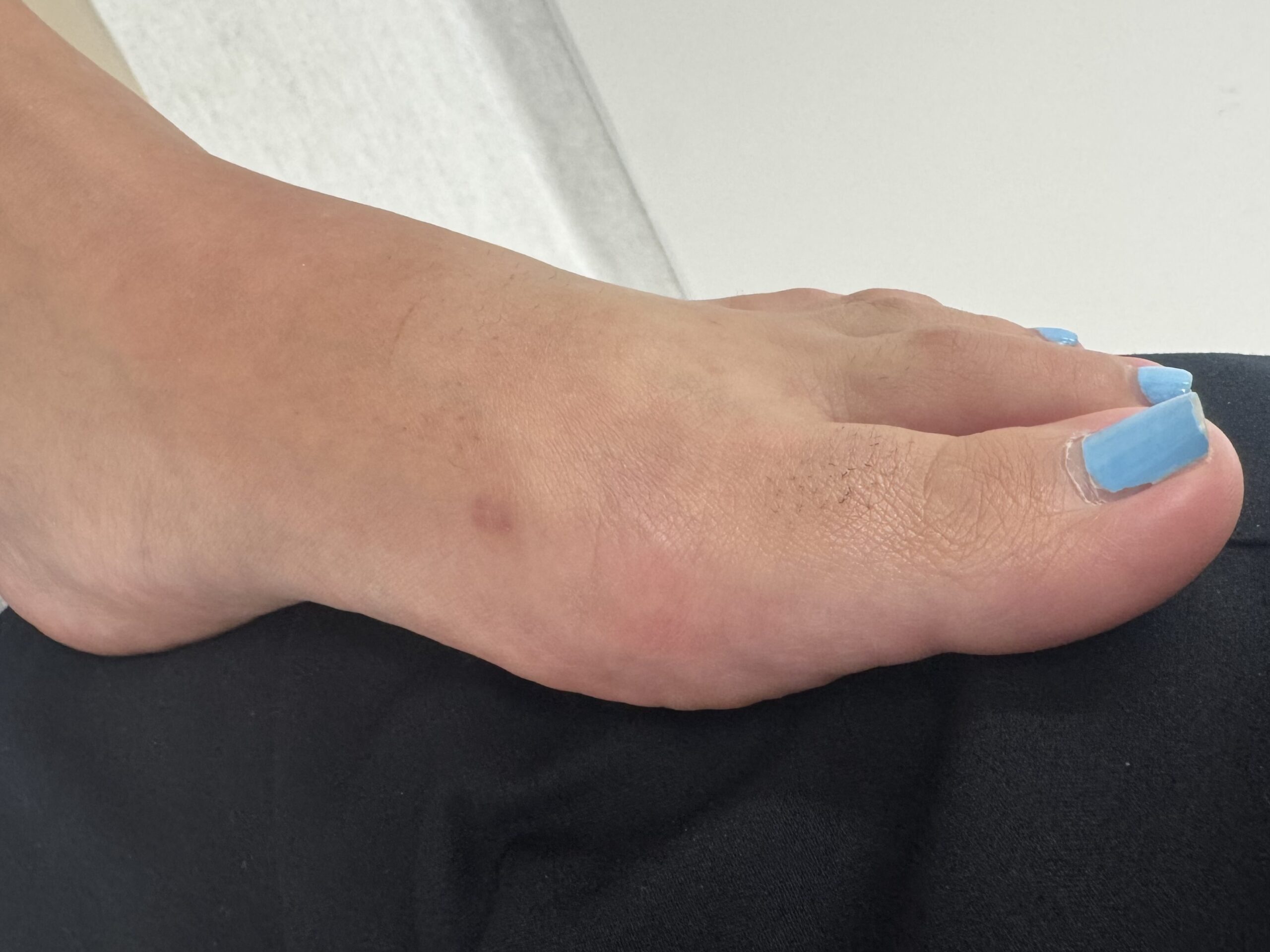 After Surgery