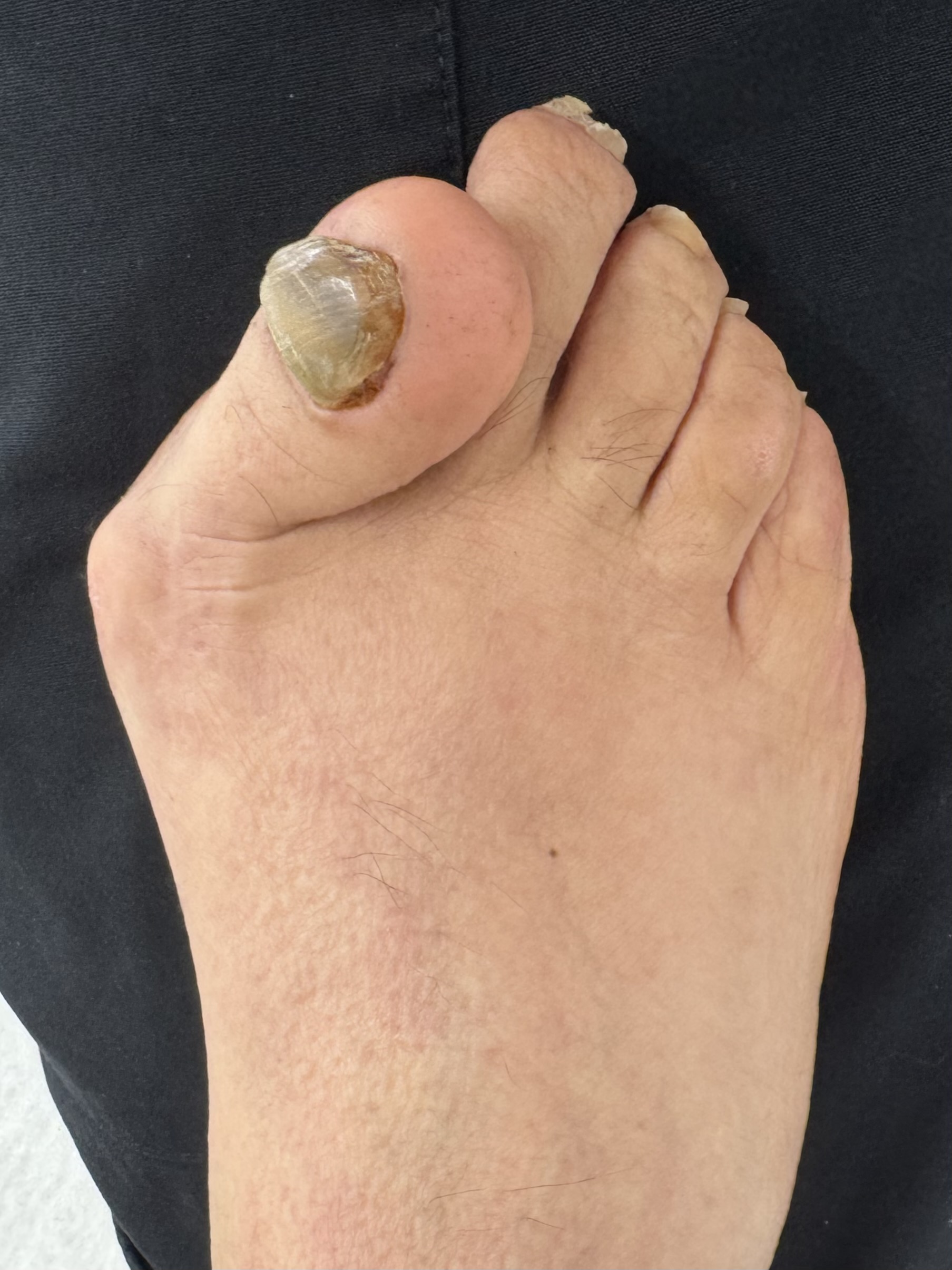 Extreme Bunion before treatment — comparison 36