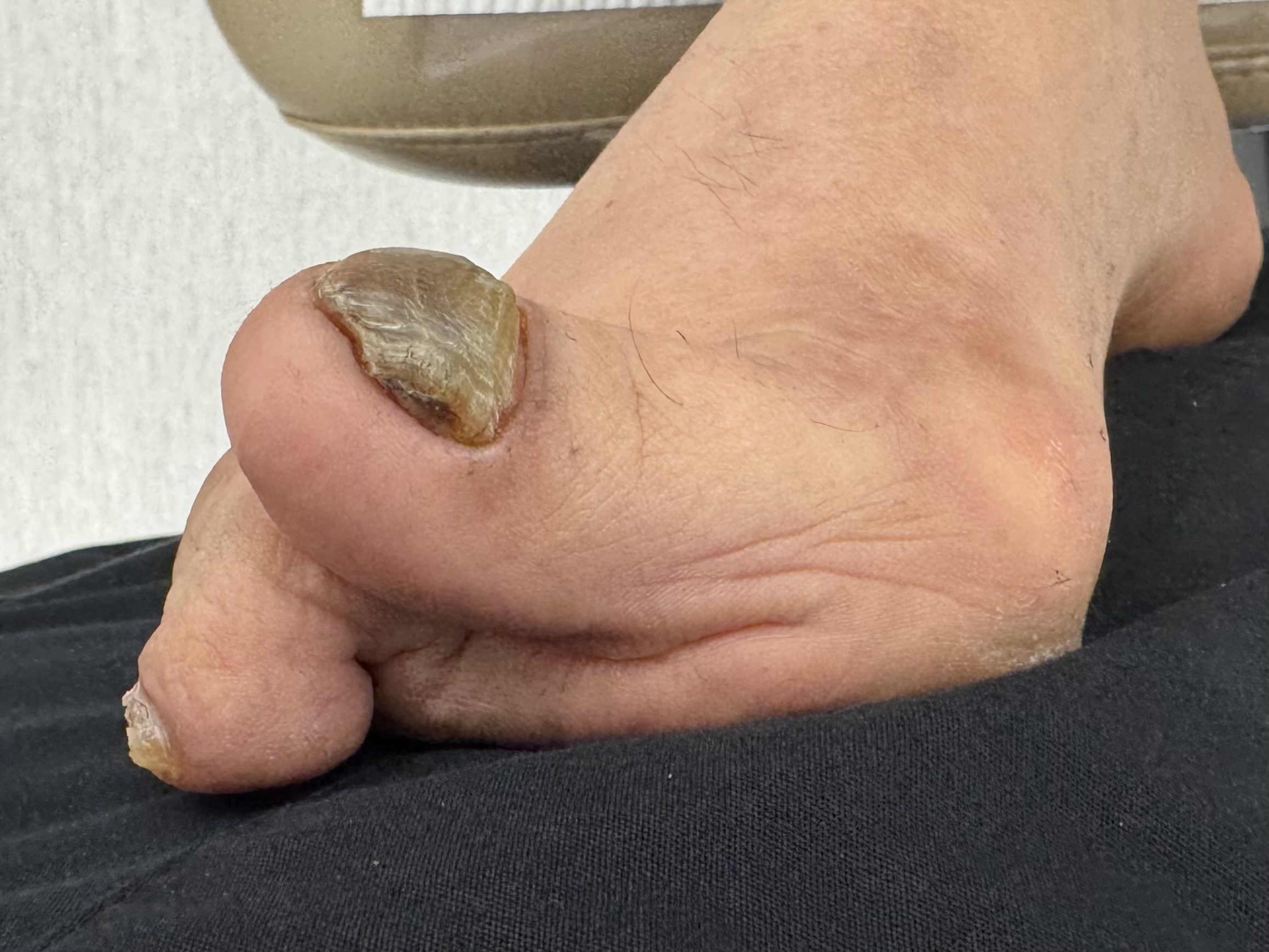 Extreme Bunion before treatment — comparison 42