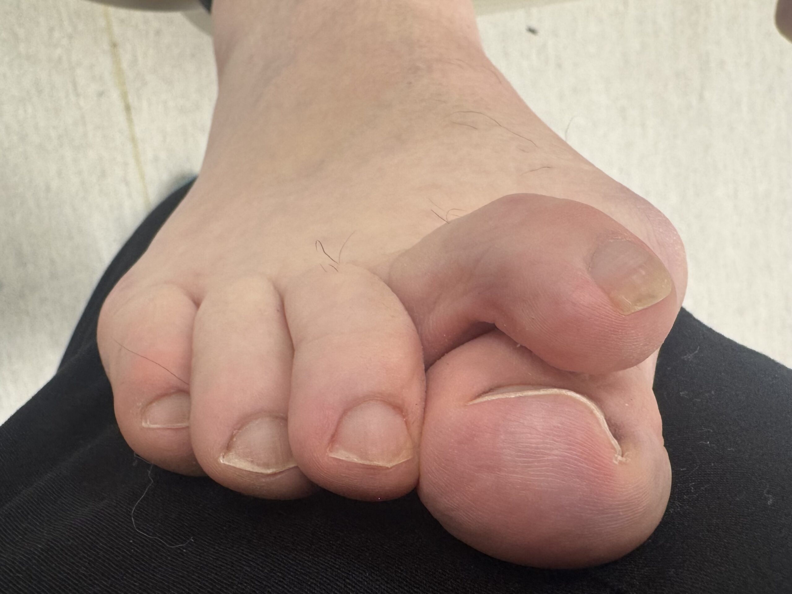 Extreme Bunion before treatment — comparison 10