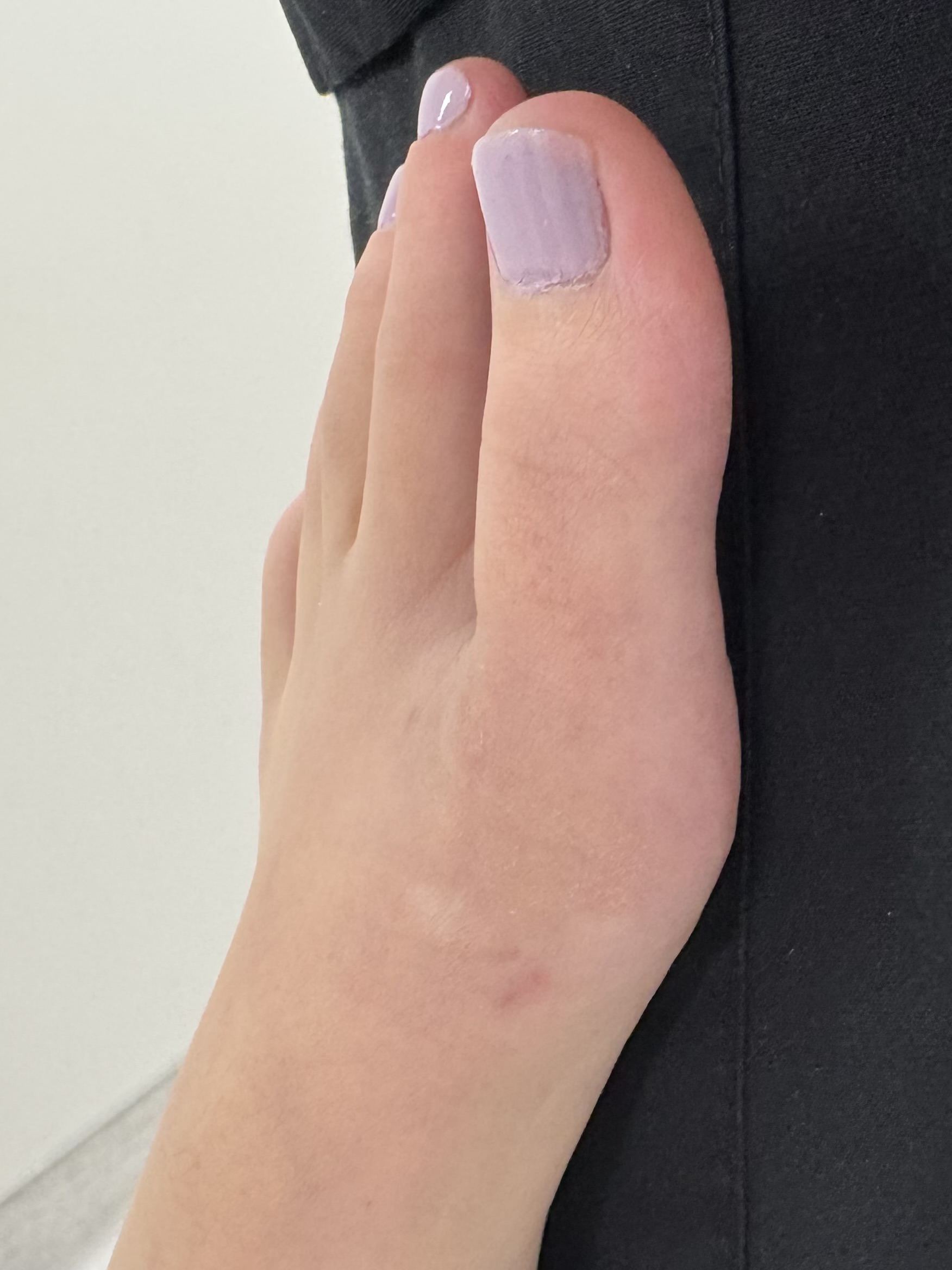 After Surgery