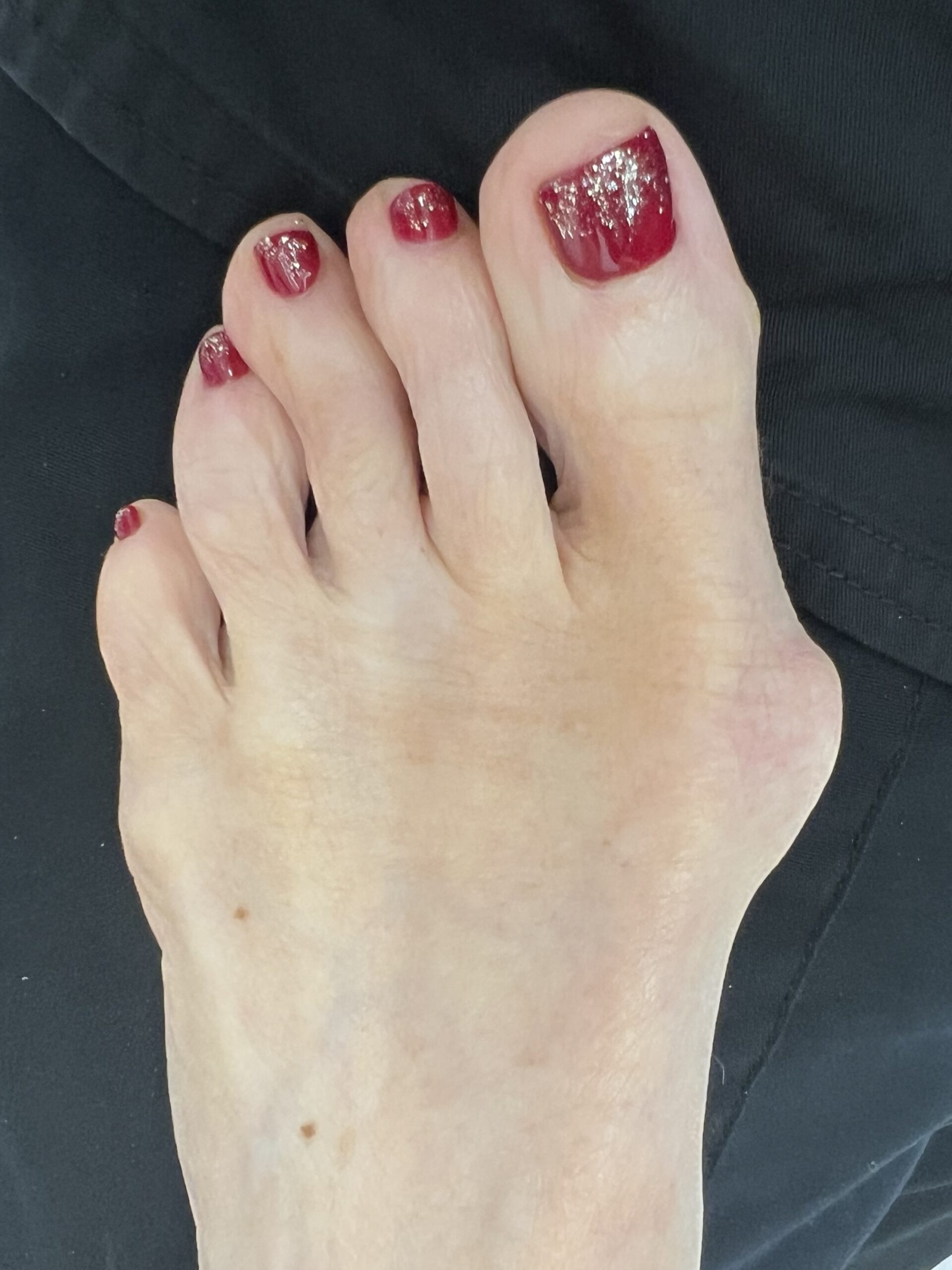 left foot before surgery