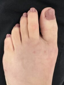 After Surgery