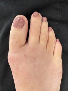 After Surgery