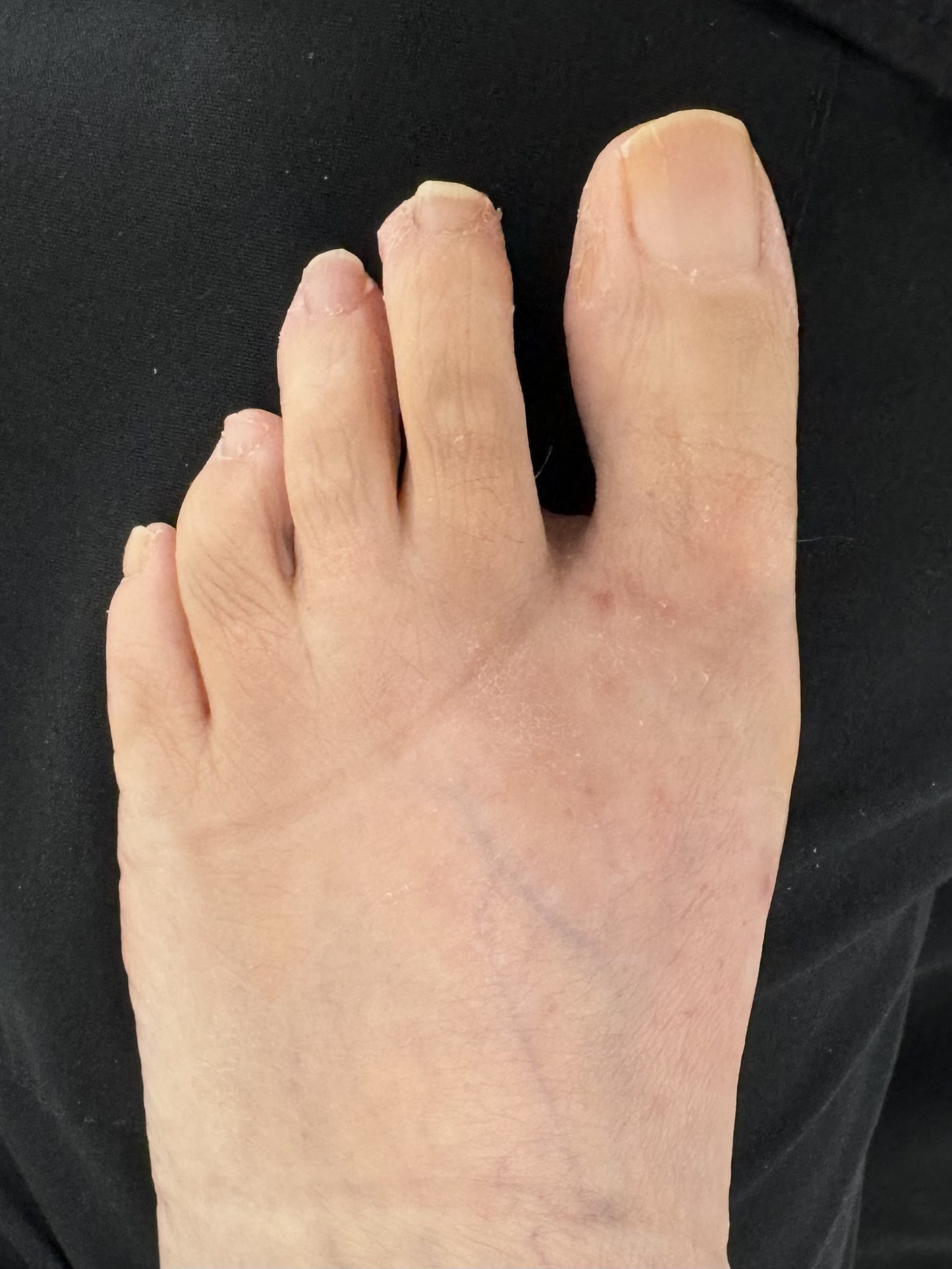 After Surgery