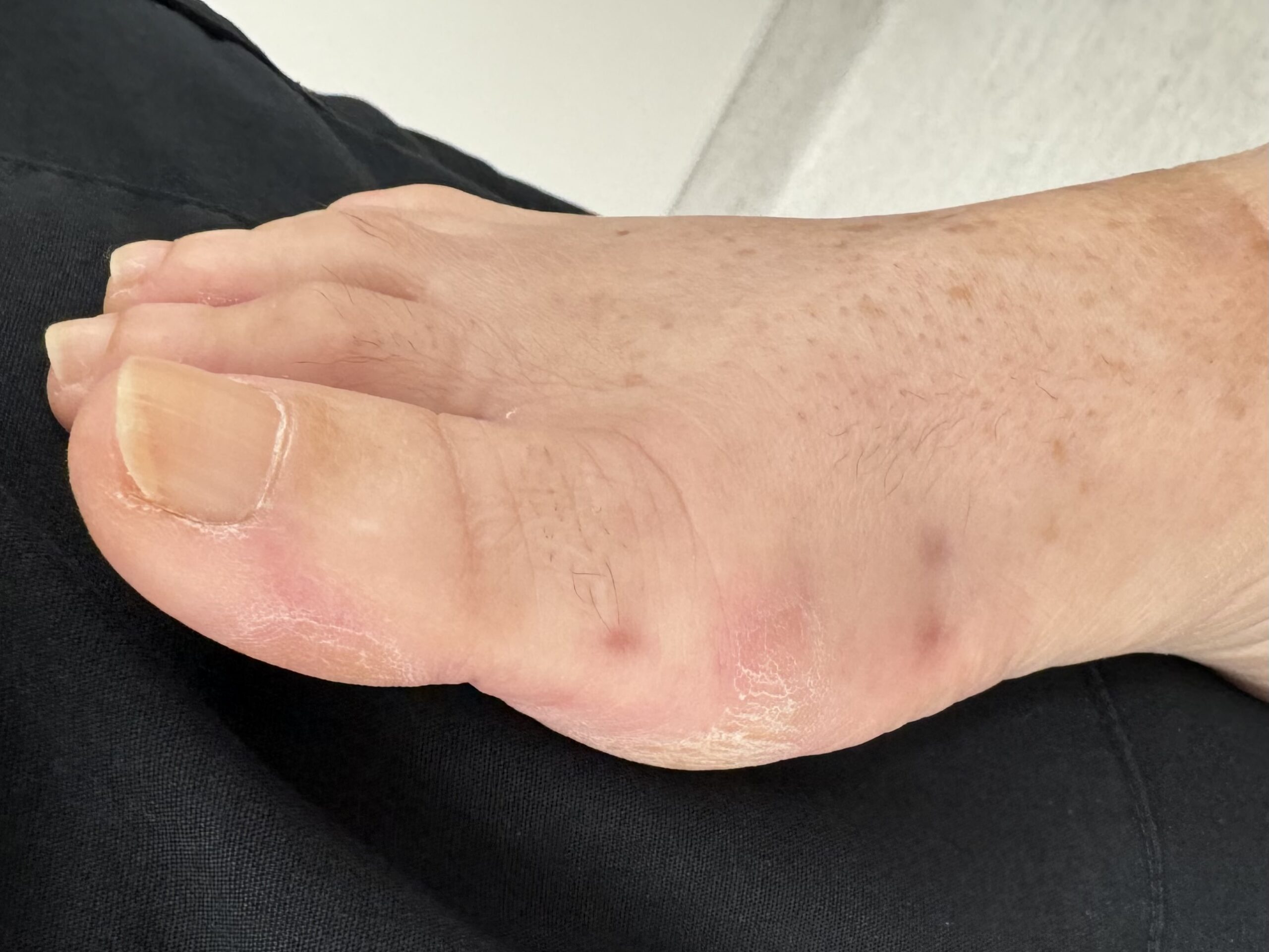 After Surgery
