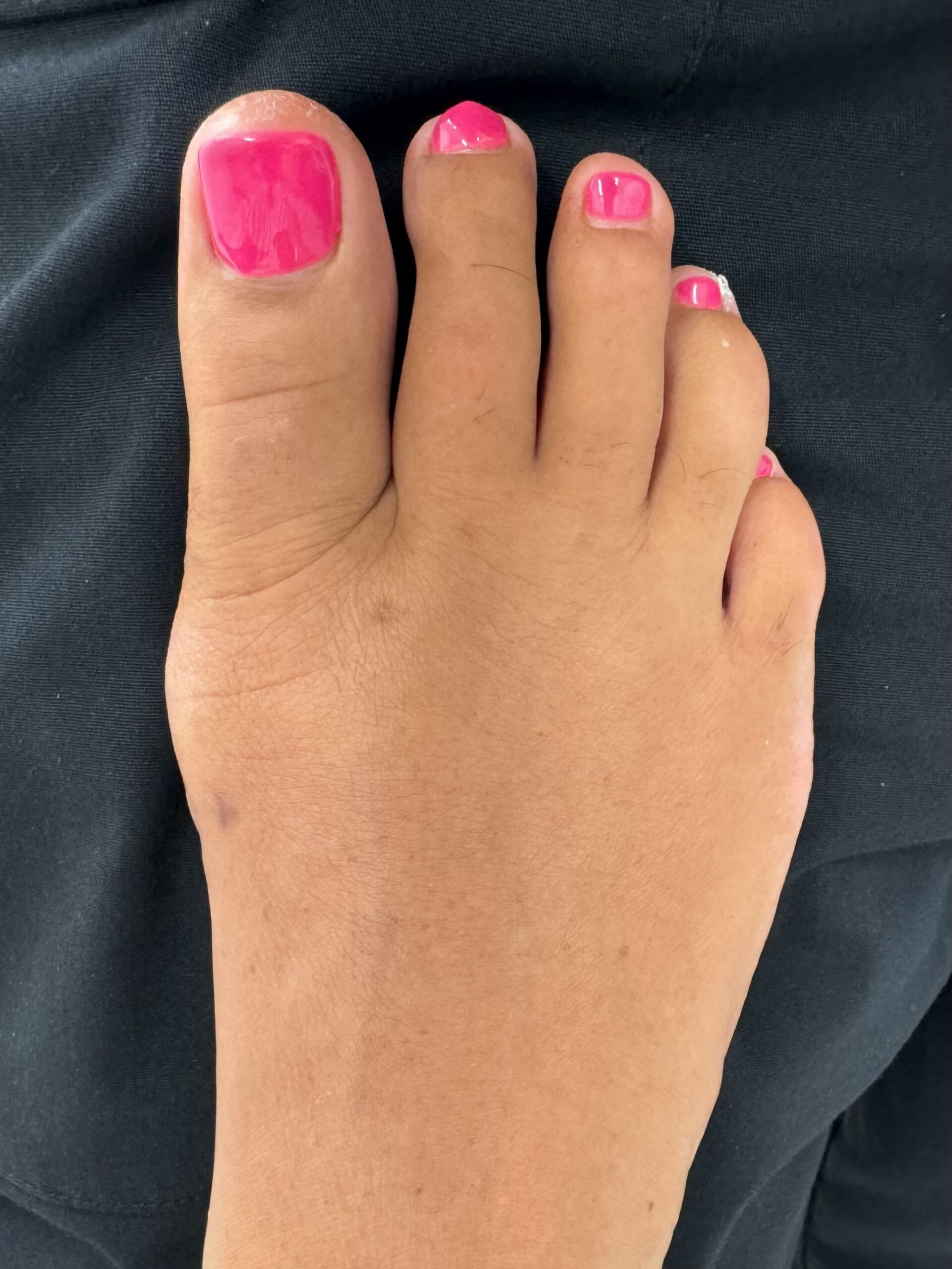 After Surgery