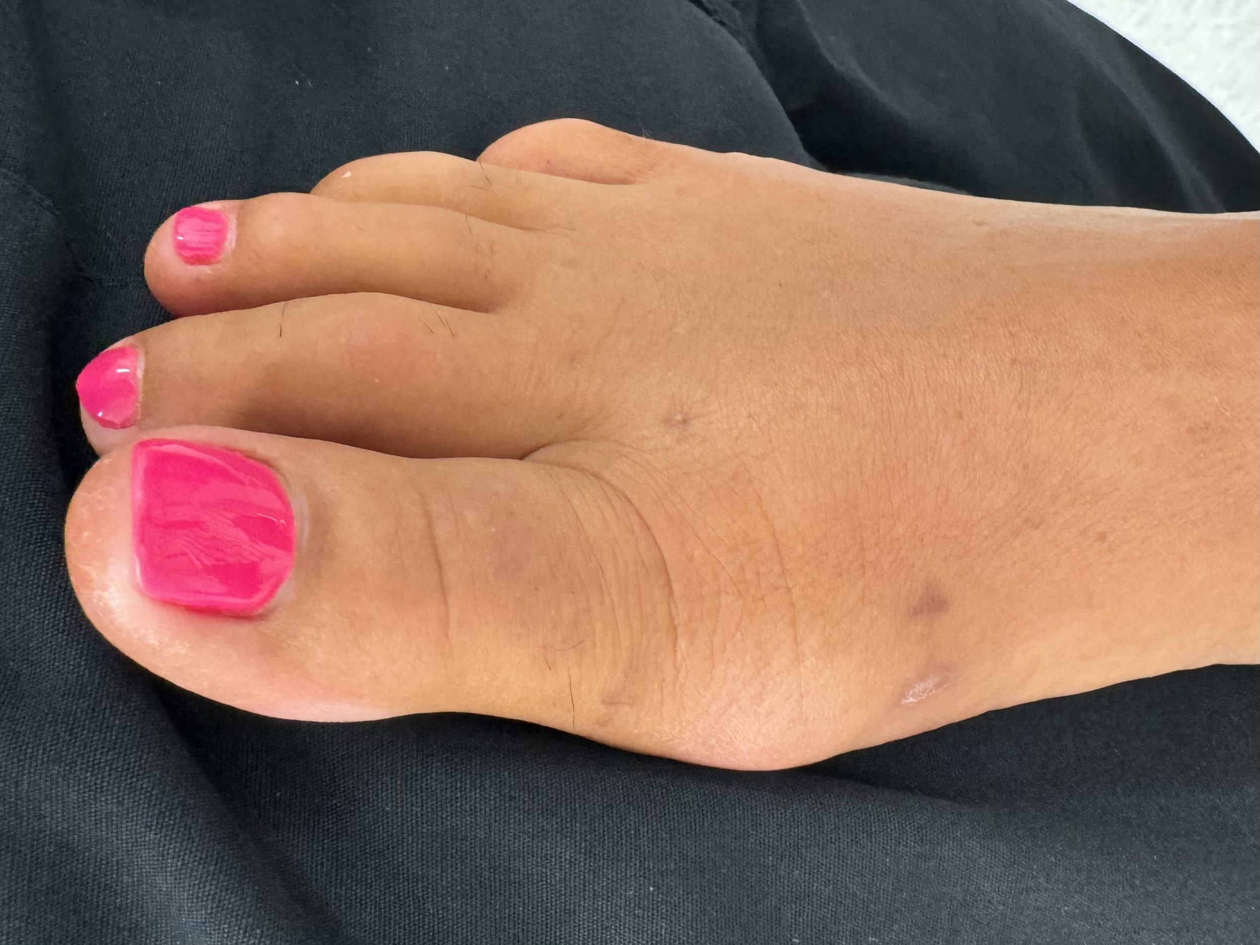 After Surgery
