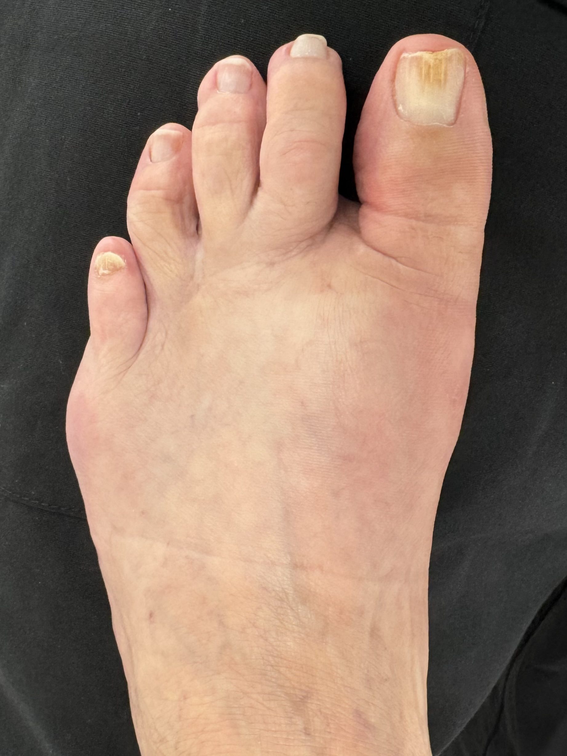 After Surgery