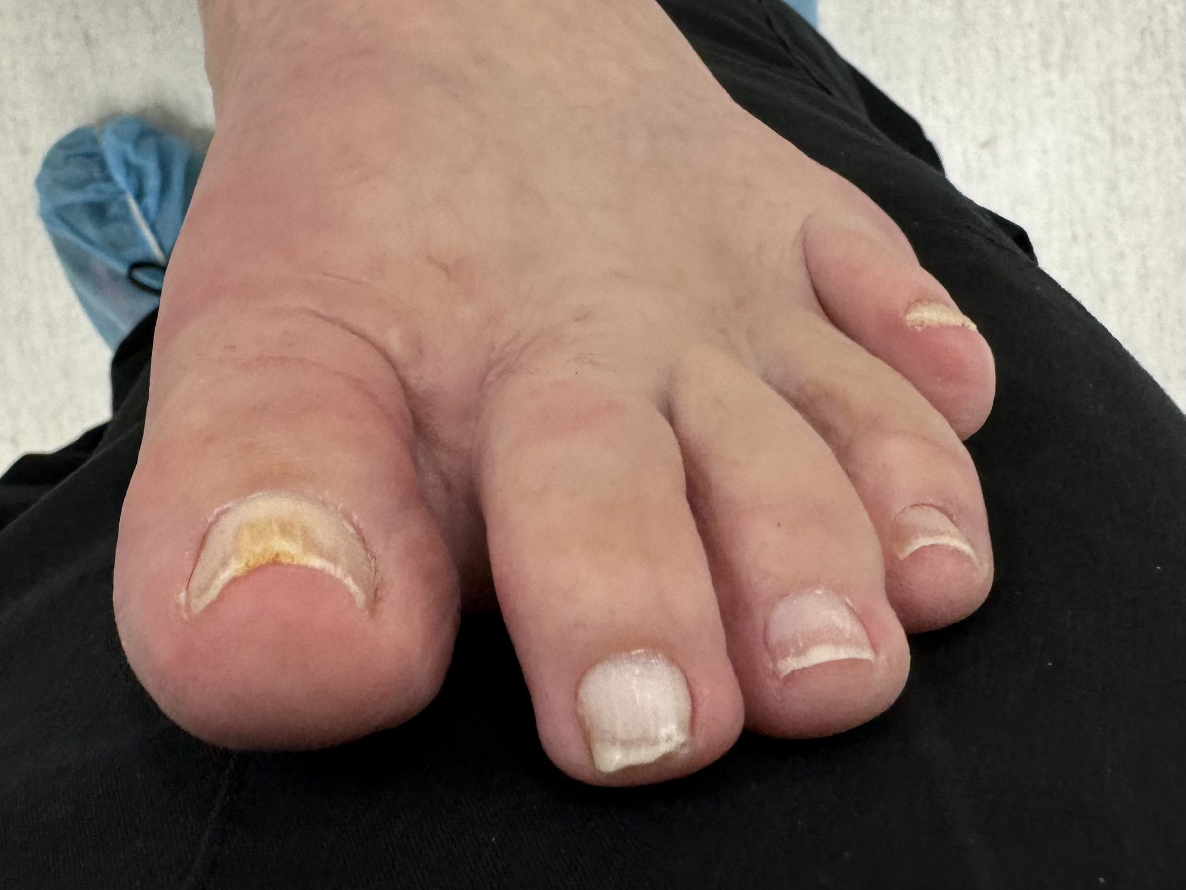 After Surgery