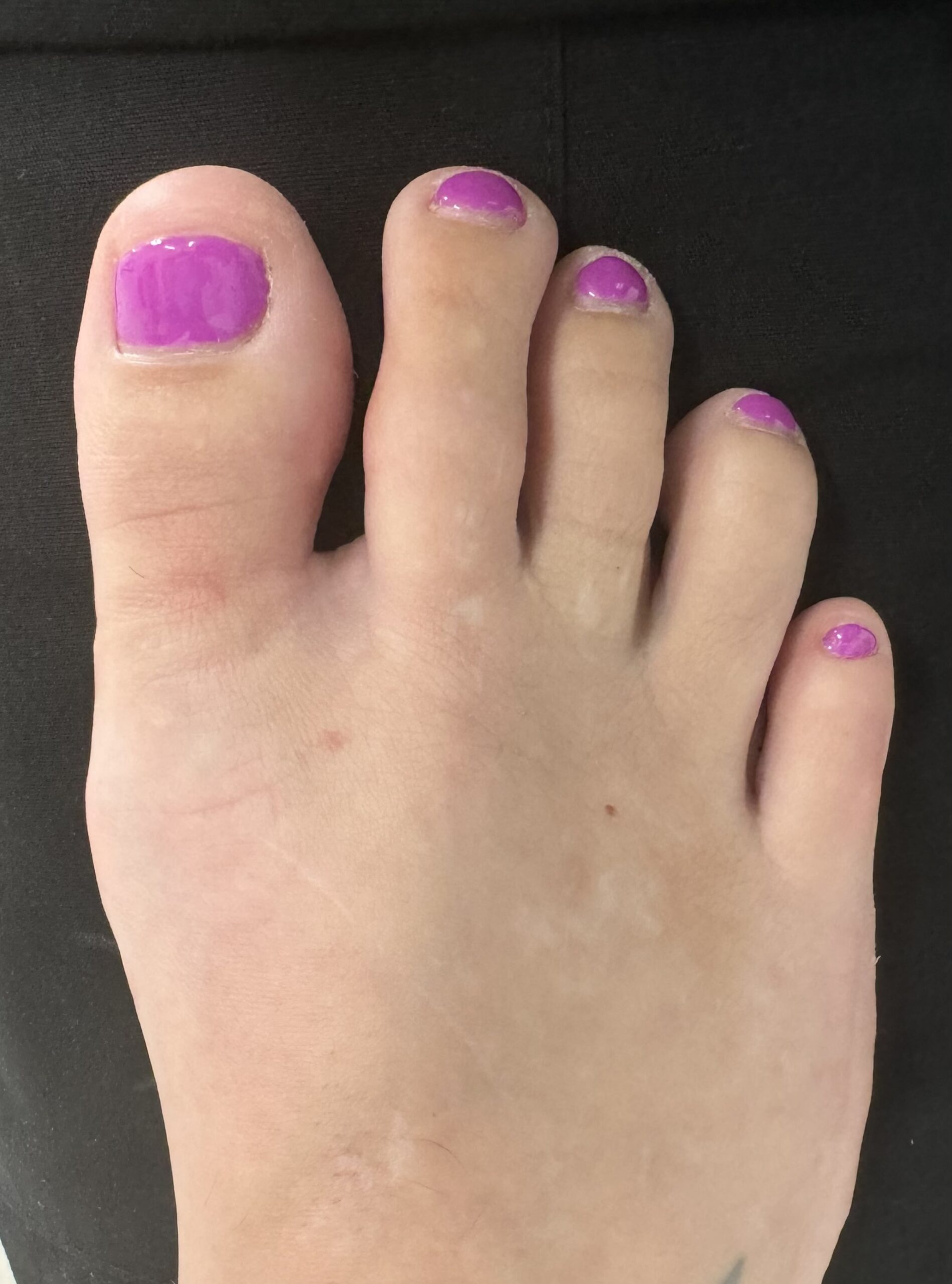 After Surgery