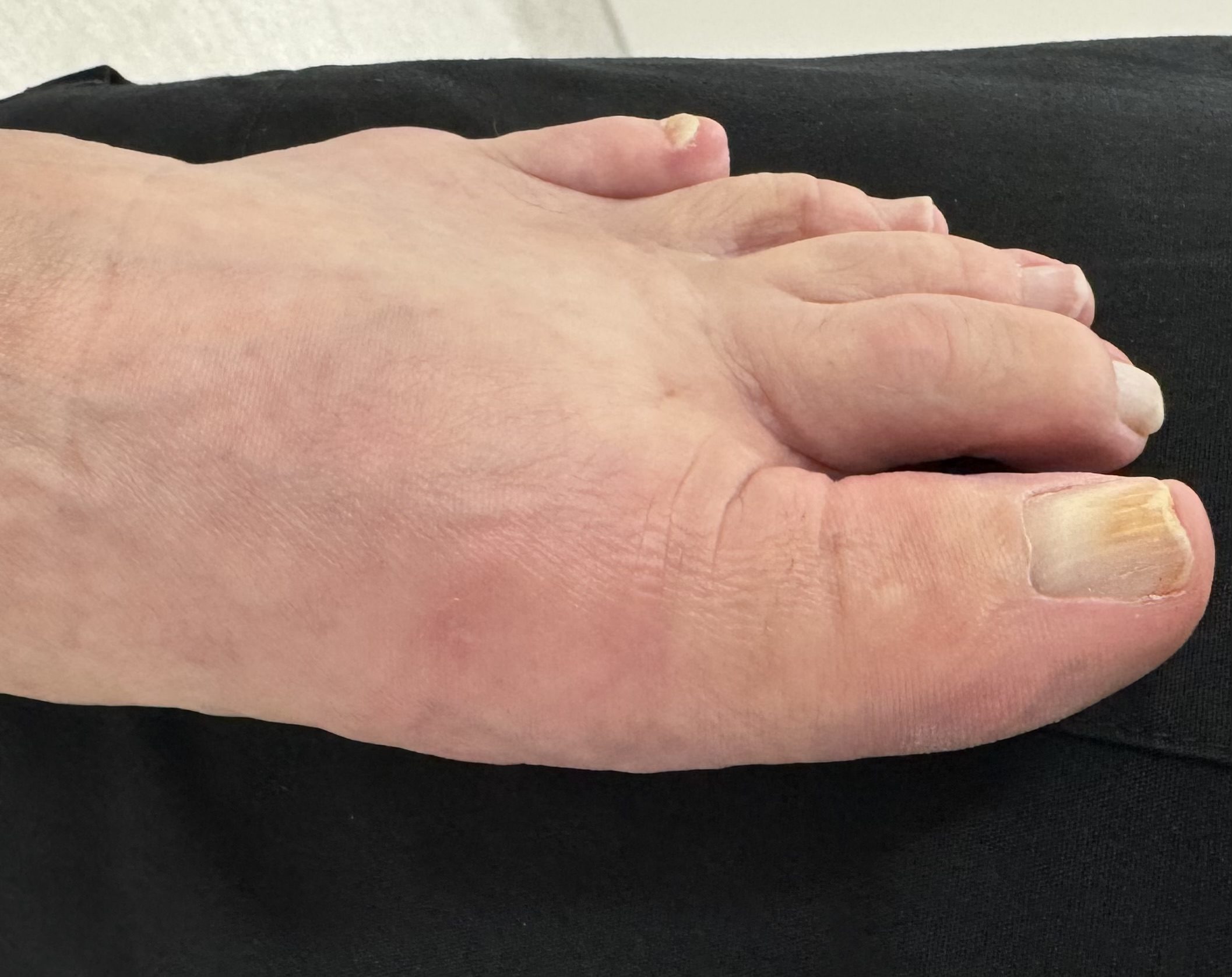 After Surgery