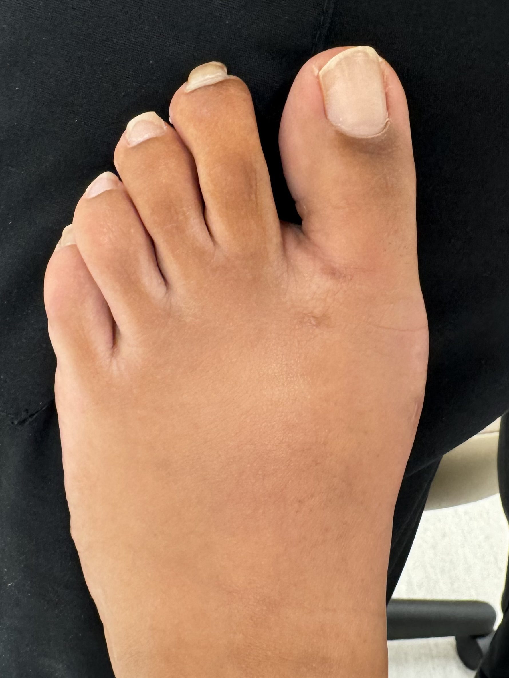 After Surgery