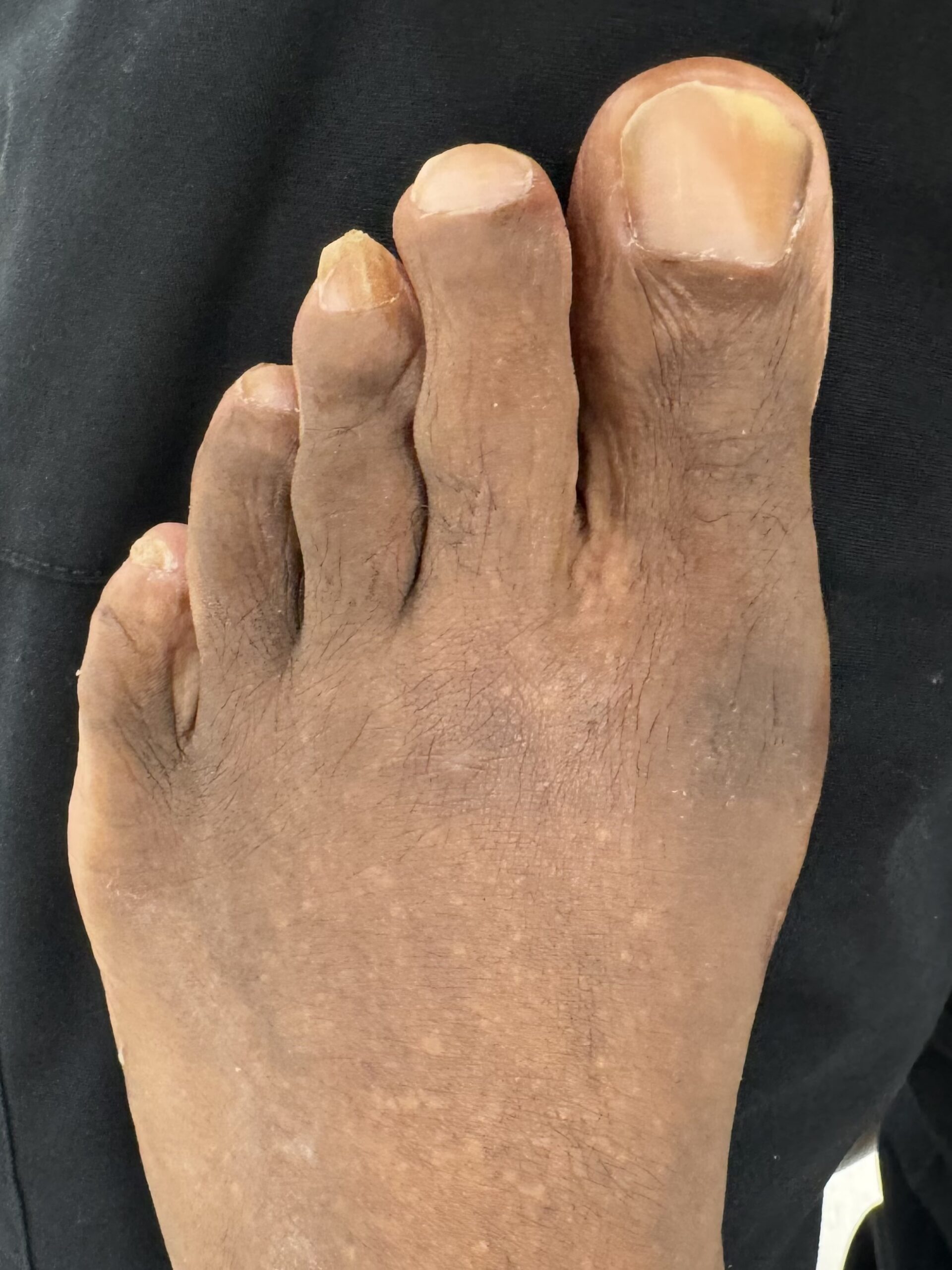 After Surgery