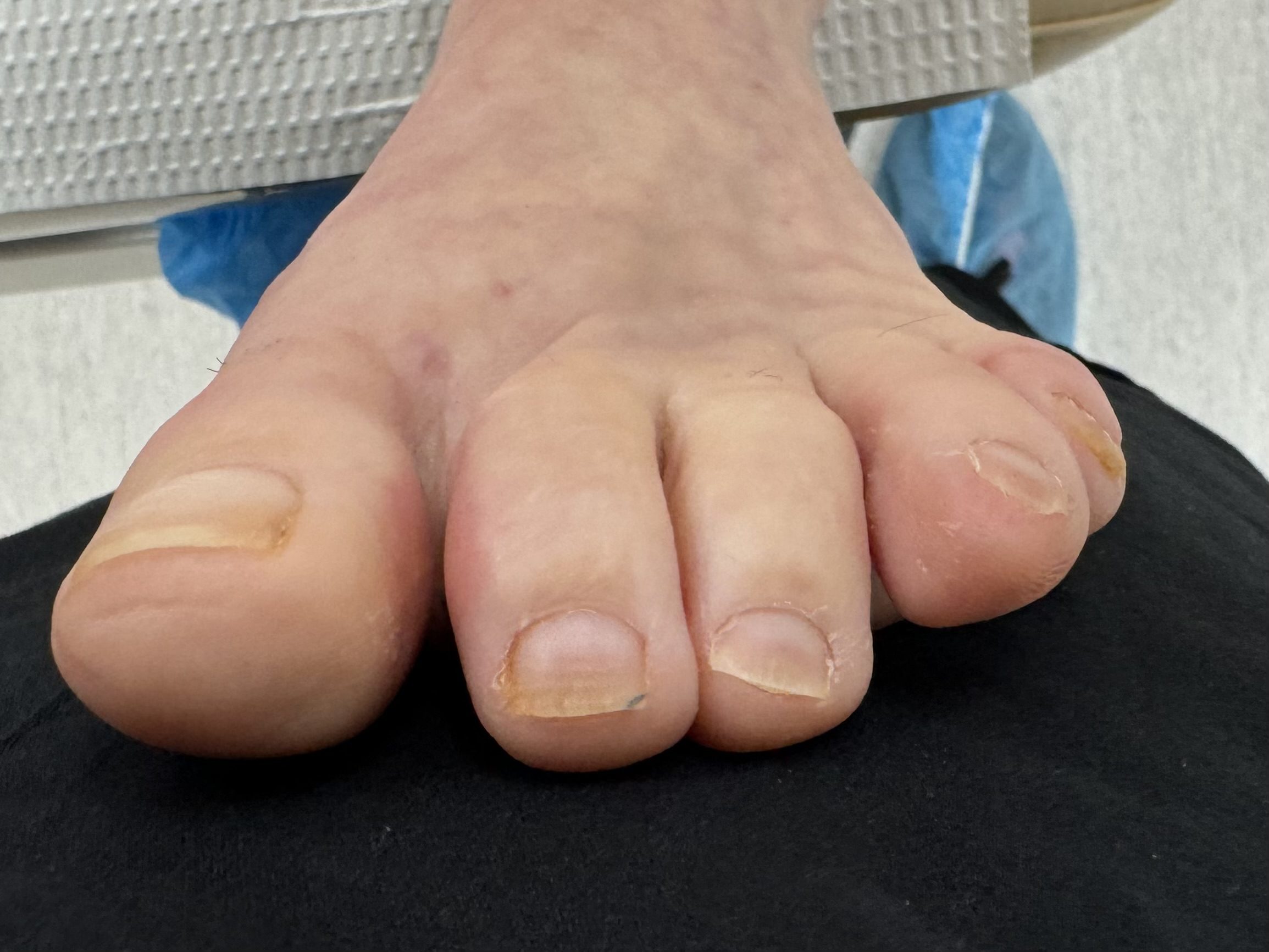 After Surgery