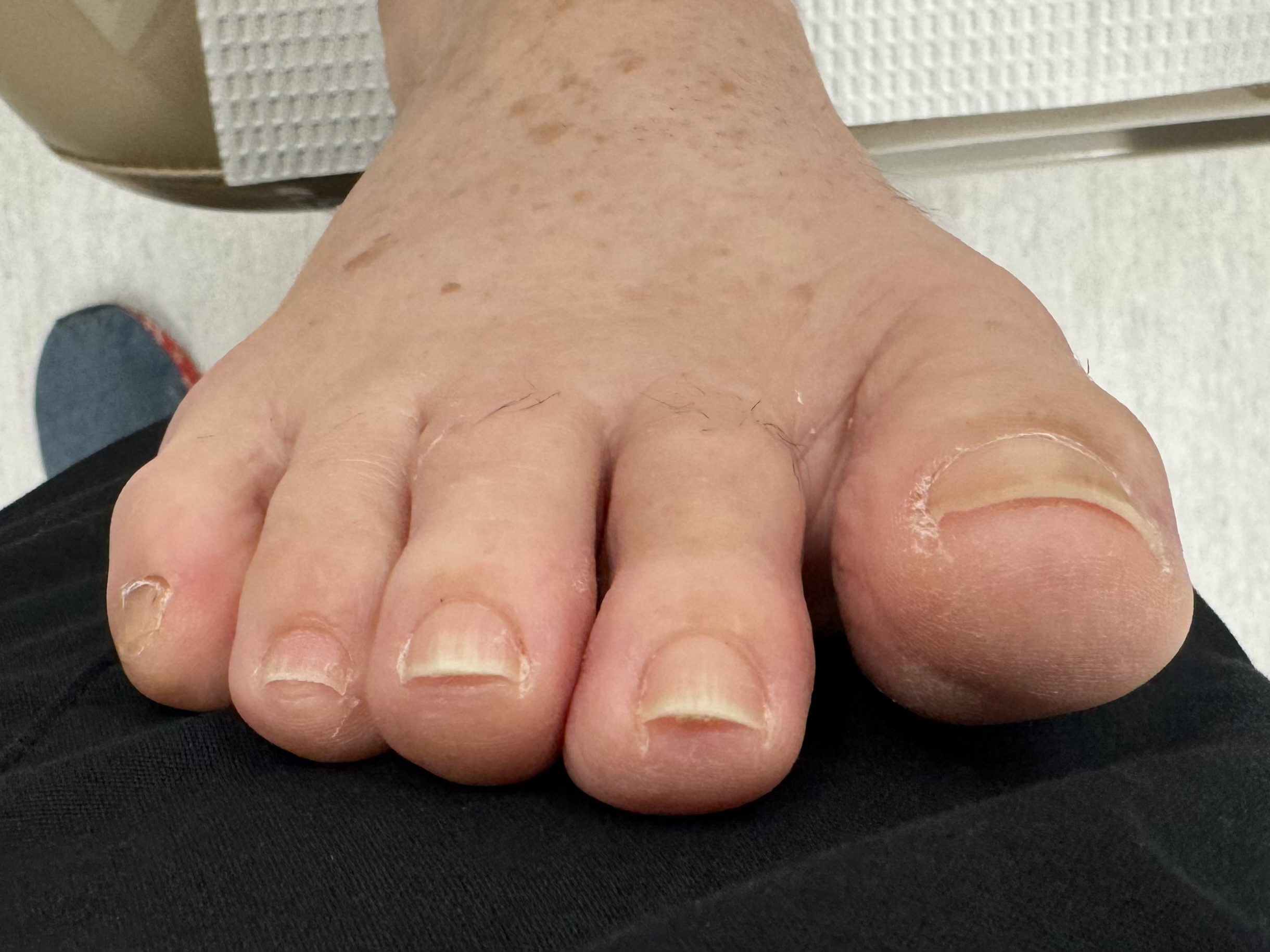 After Surgery
