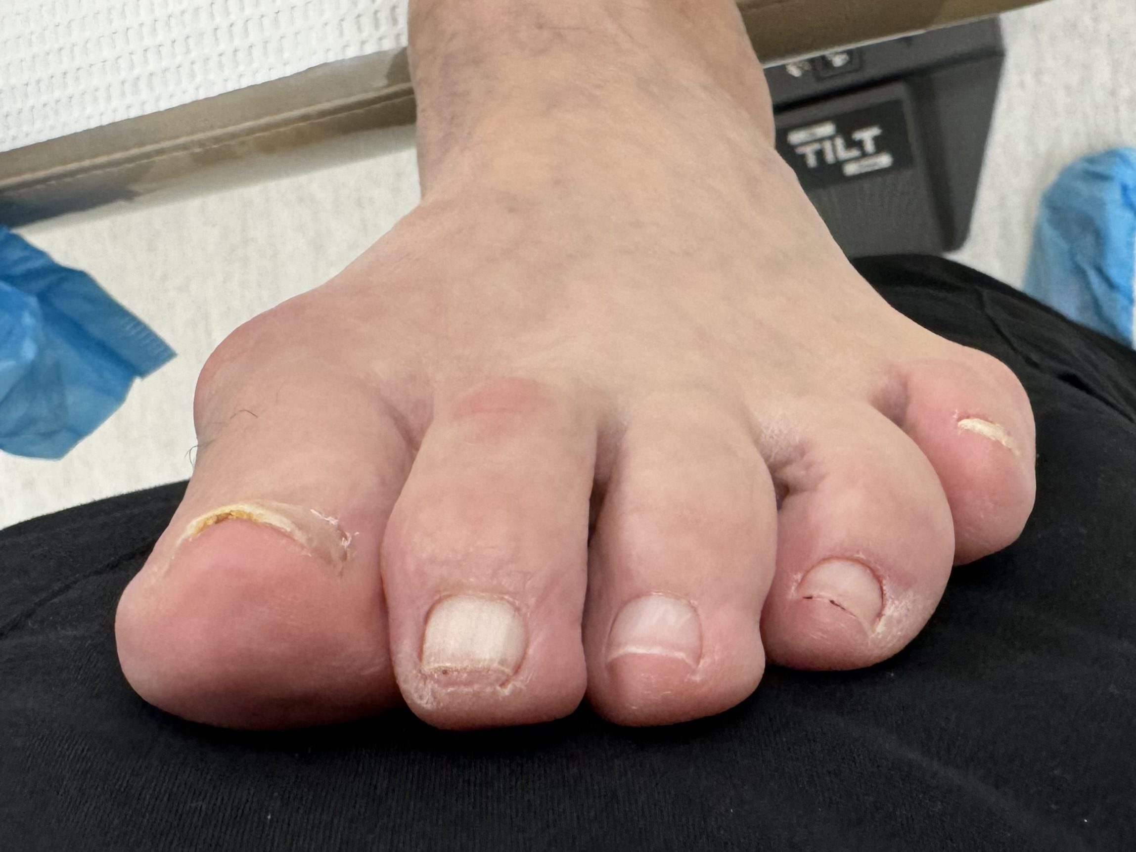 Before Surgery