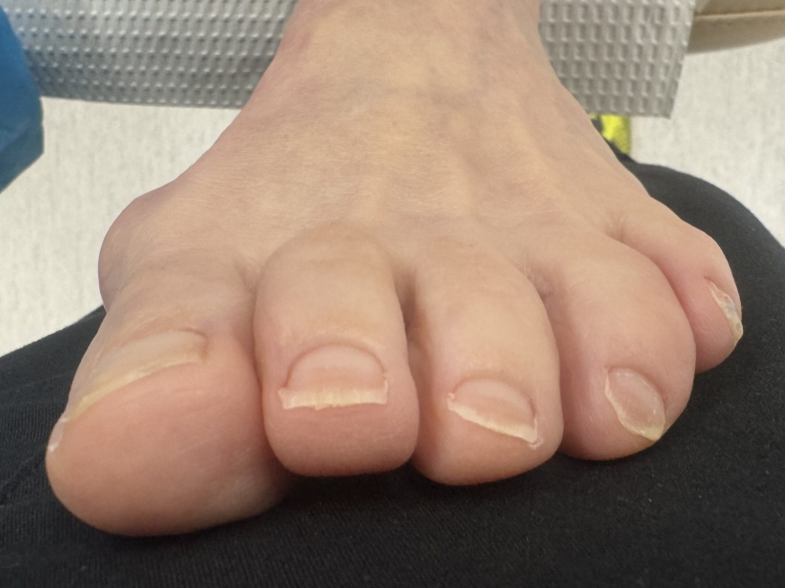 Before Surgery