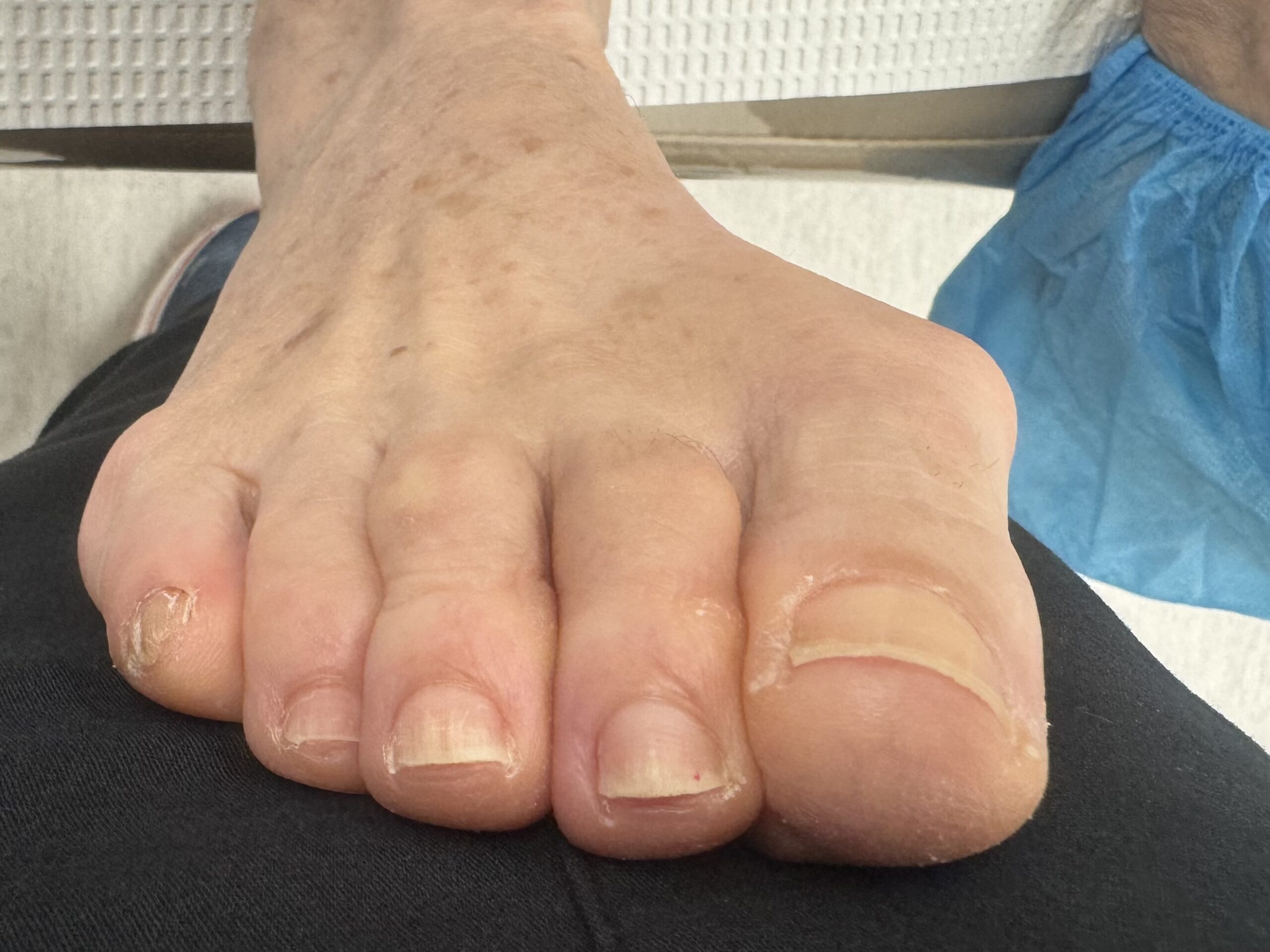Before Surgery
