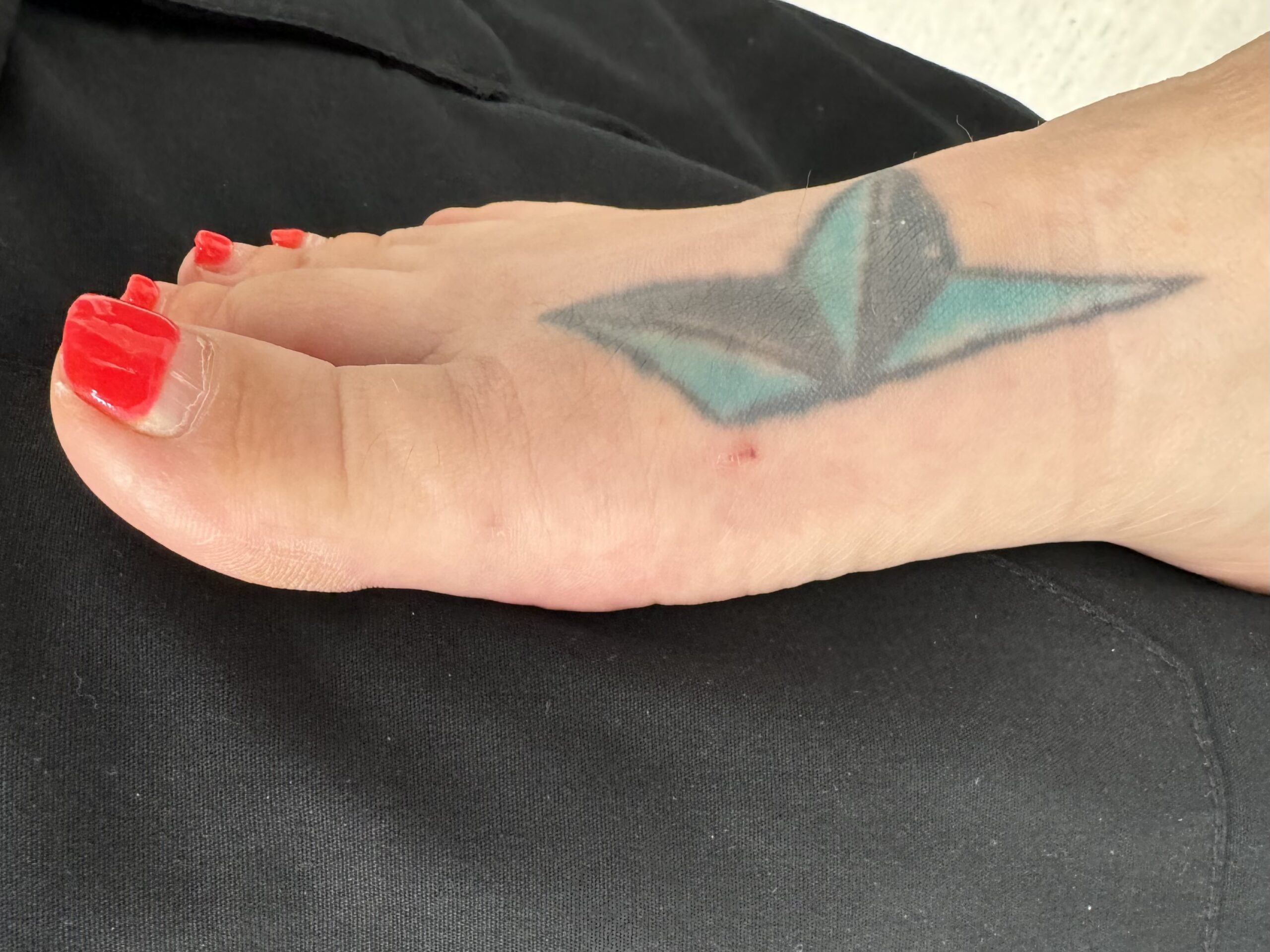After Surgery