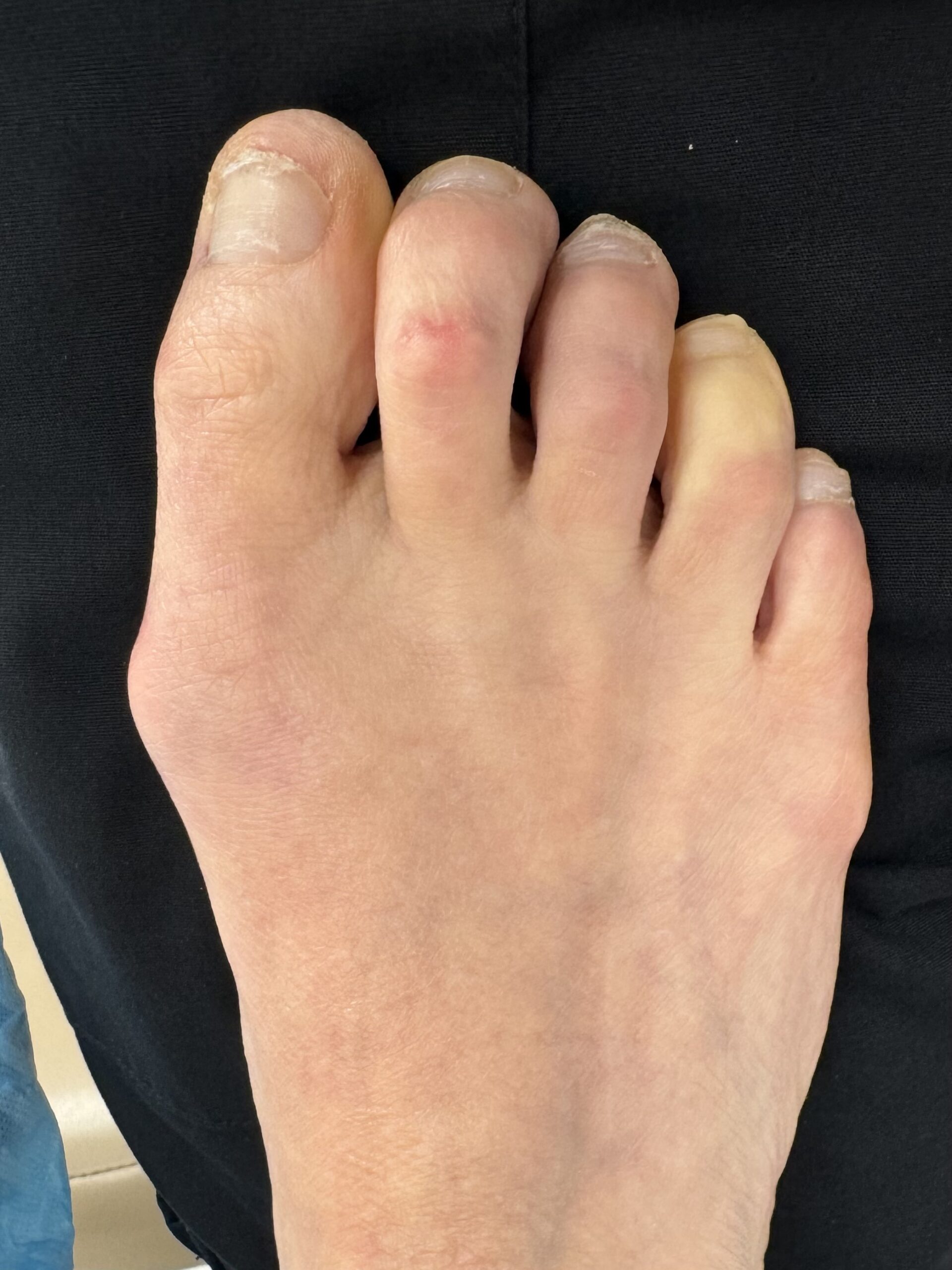 Before Surgery