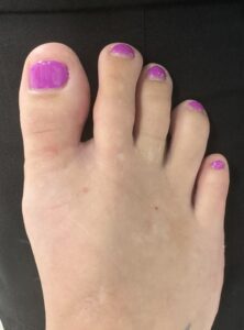 After Surgery