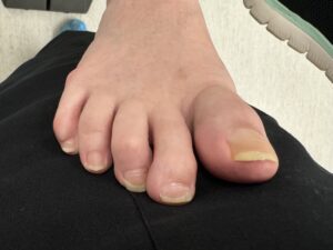 After Surgery