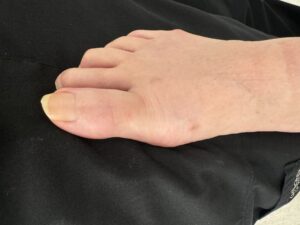 After Surgery