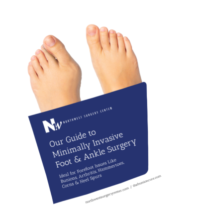 How Long Before You Can Walk After Hammertoe Surgery? | Northwest ...