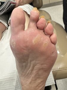 After Surgery