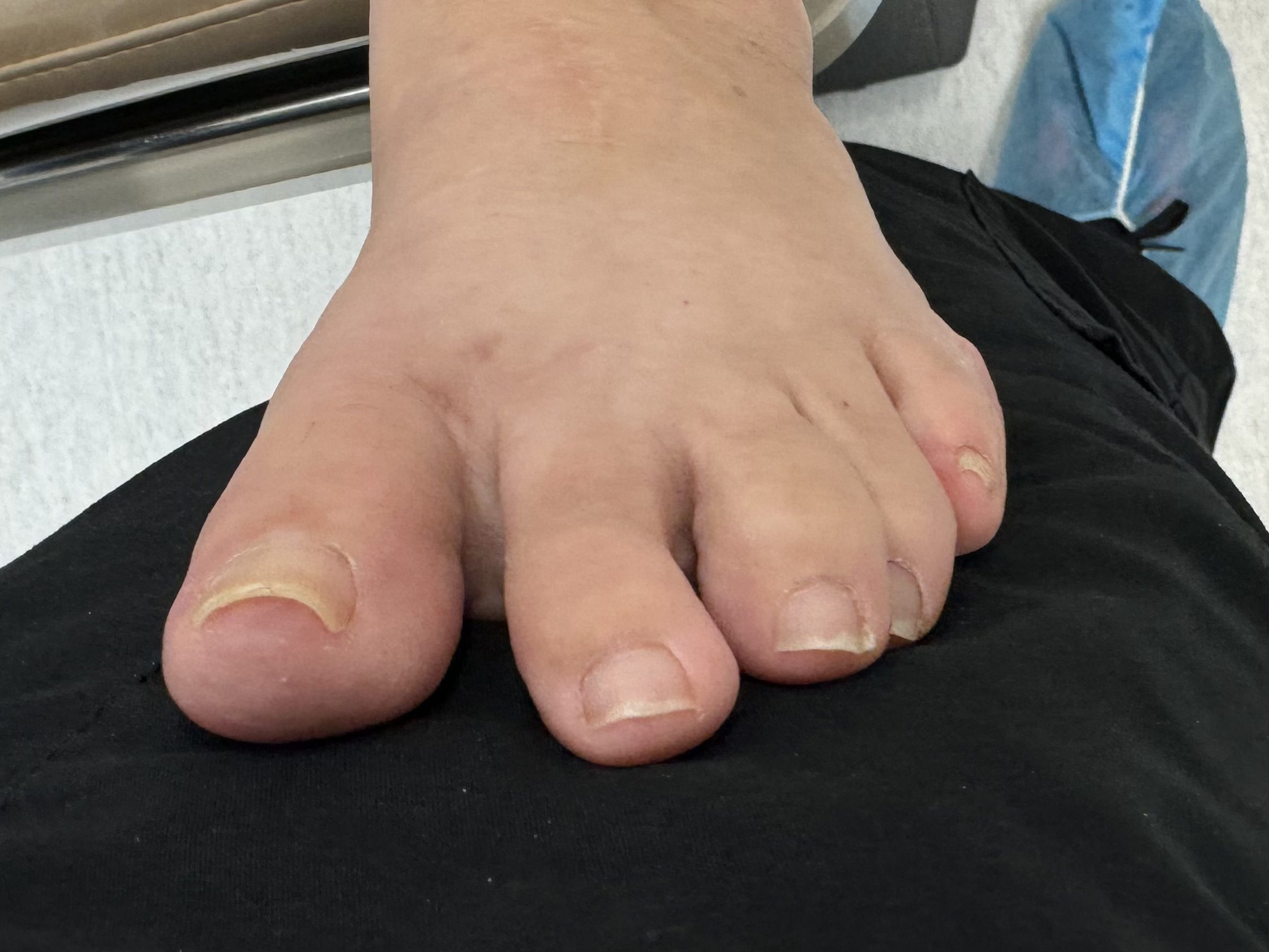 After Surgery