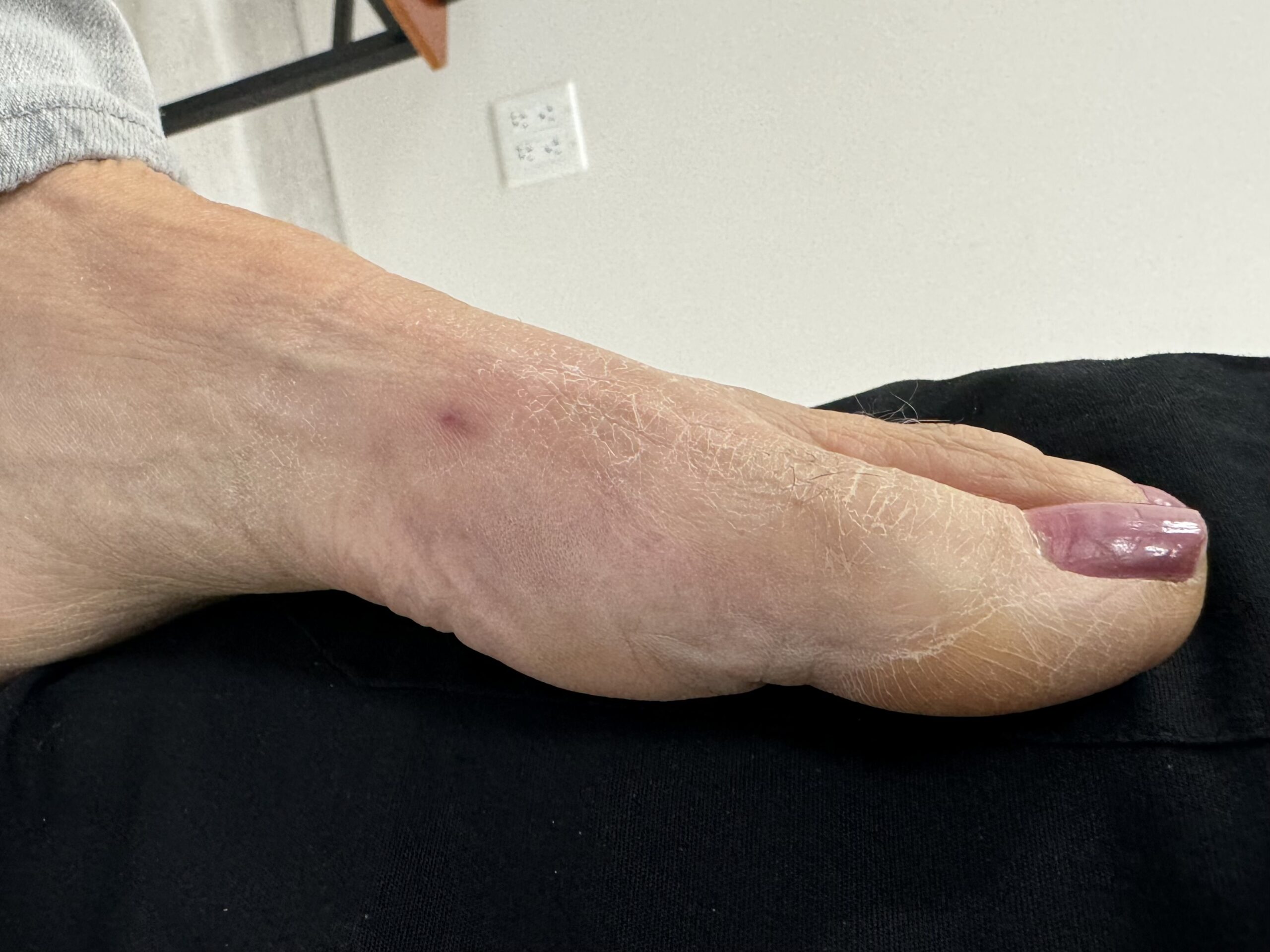 After Surgery
