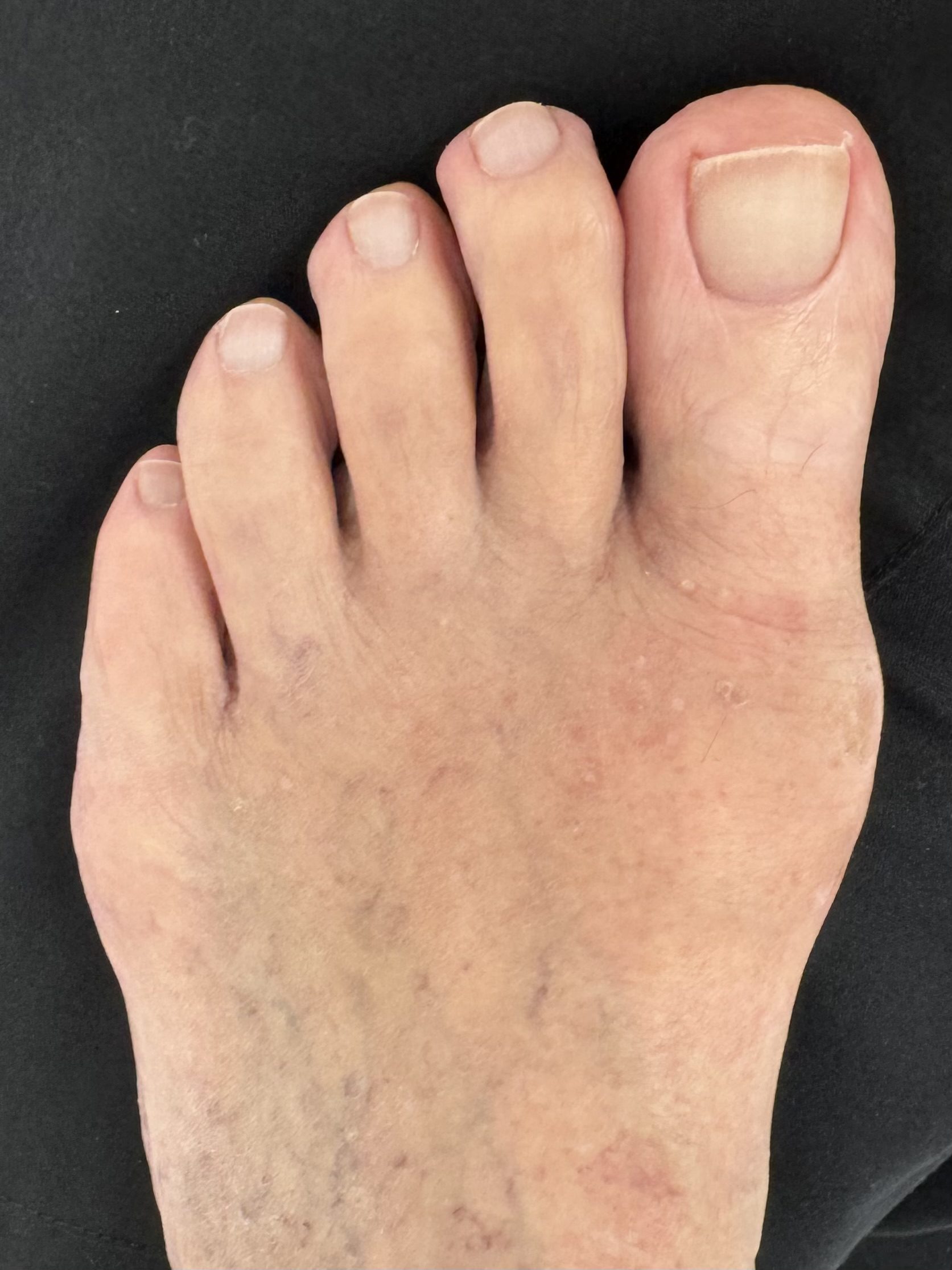 After Surgery