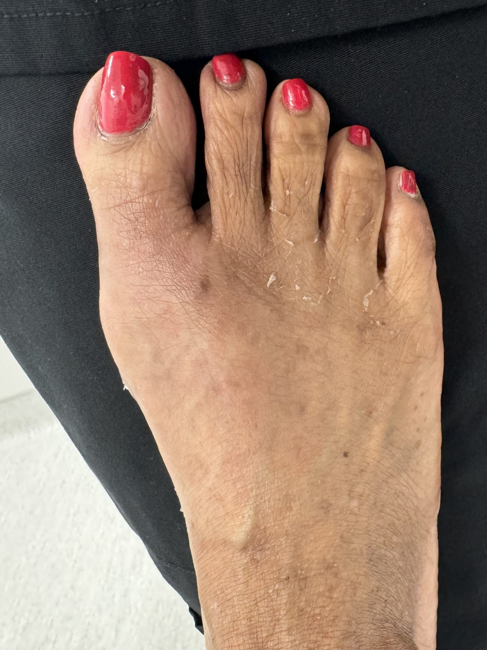 After Surgery