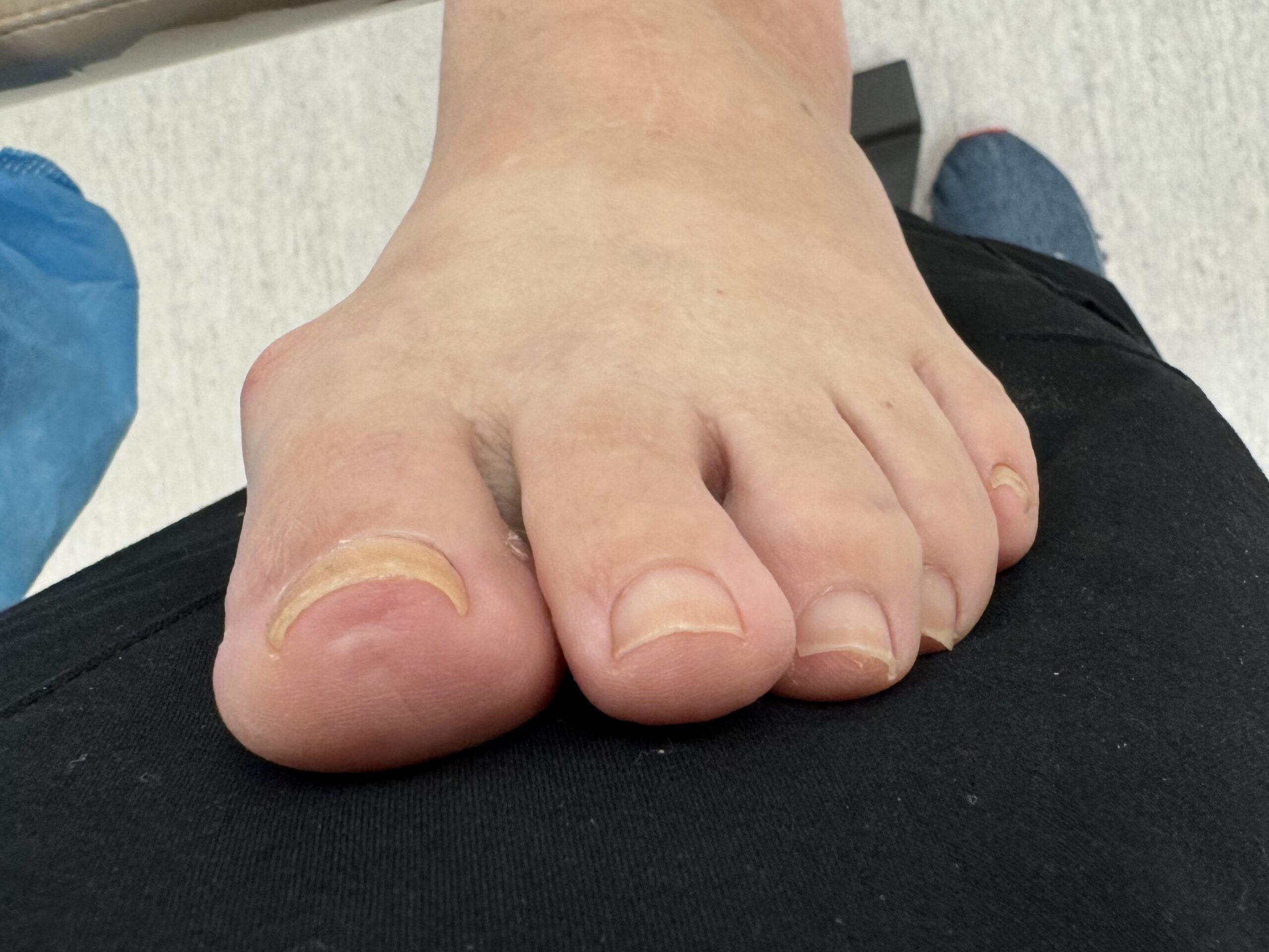 Before Surgery