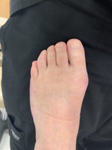 Extreme Bunion after treatment — comparison 34