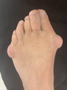Extreme Bunion before treatment — comparison 34