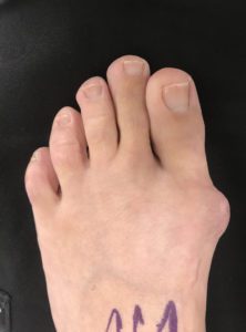 Large Bunion before treatment — comparison 94