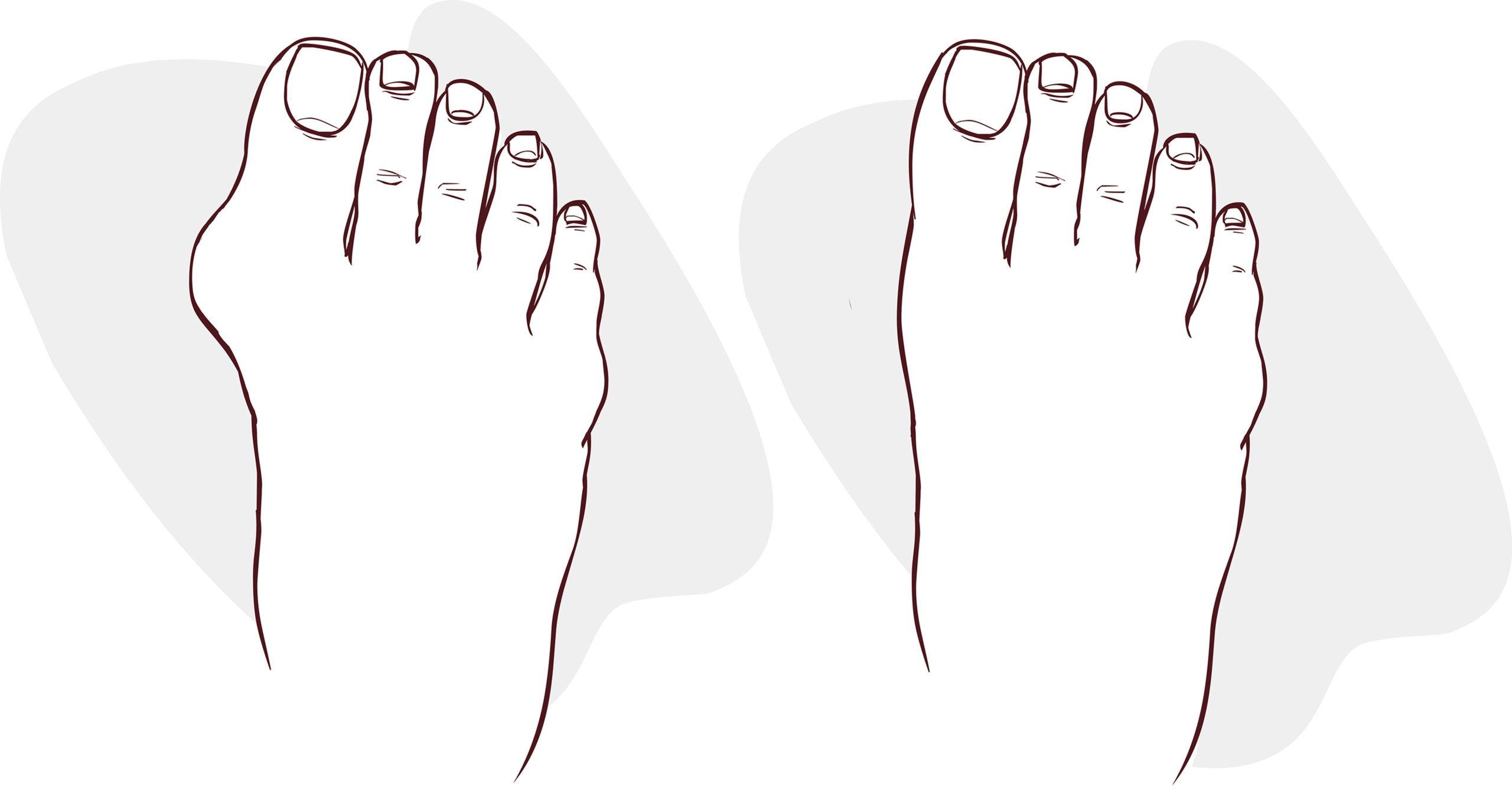 When is Hammertoe Surgery Worth It and Necessary?
