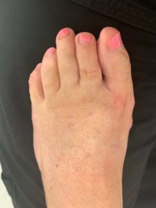 Extreme Bunion after treatment — comparison 28