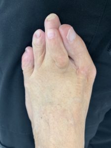 Extreme Bunion before treatment — comparison 28