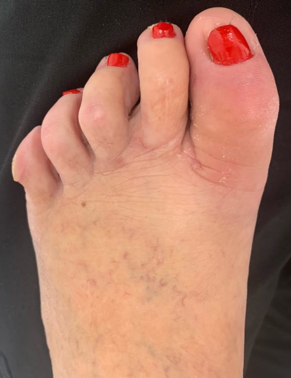 Mallet Toe after treatment — comparison 5